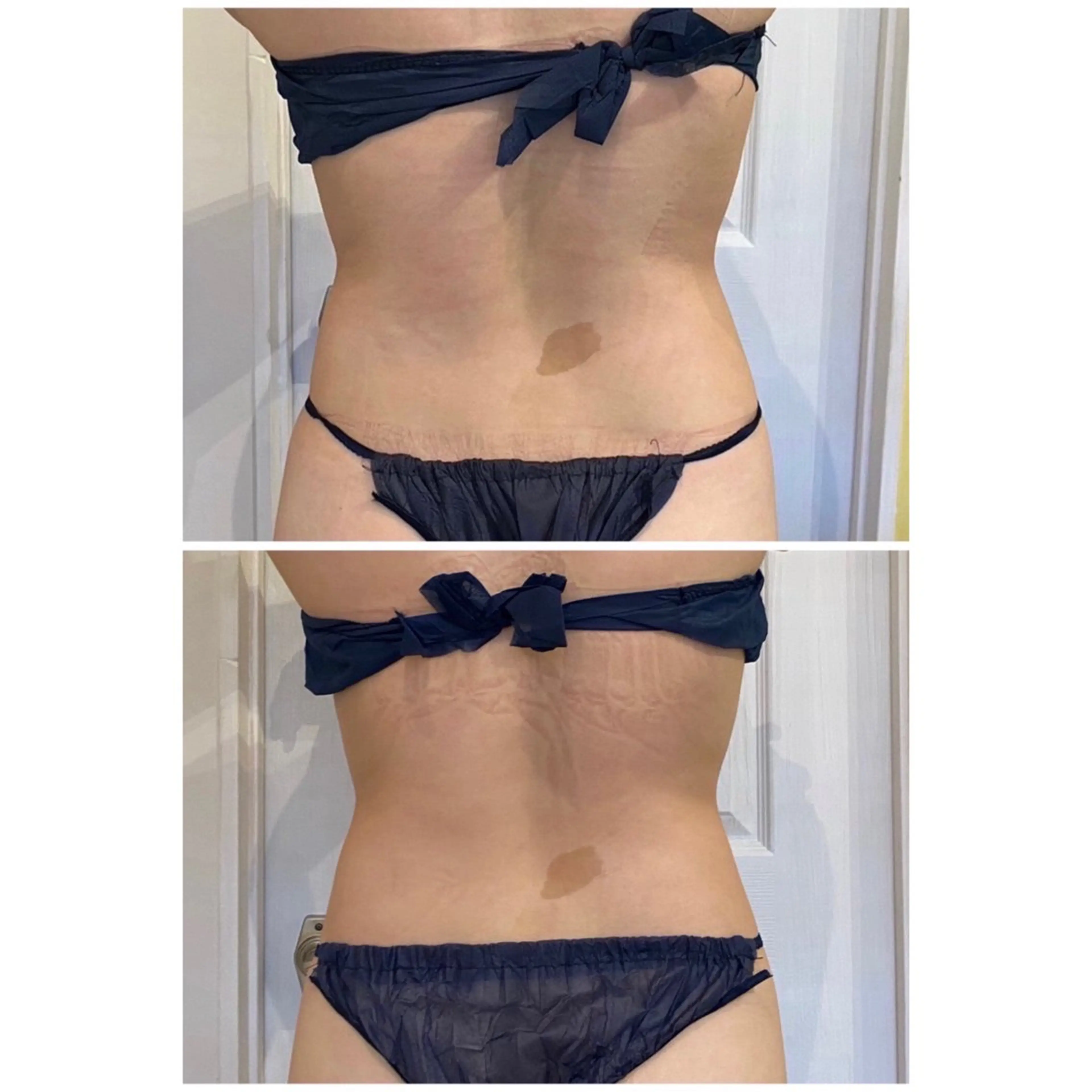 【男女】脂肪除去　身体1部位（10ml）の写真