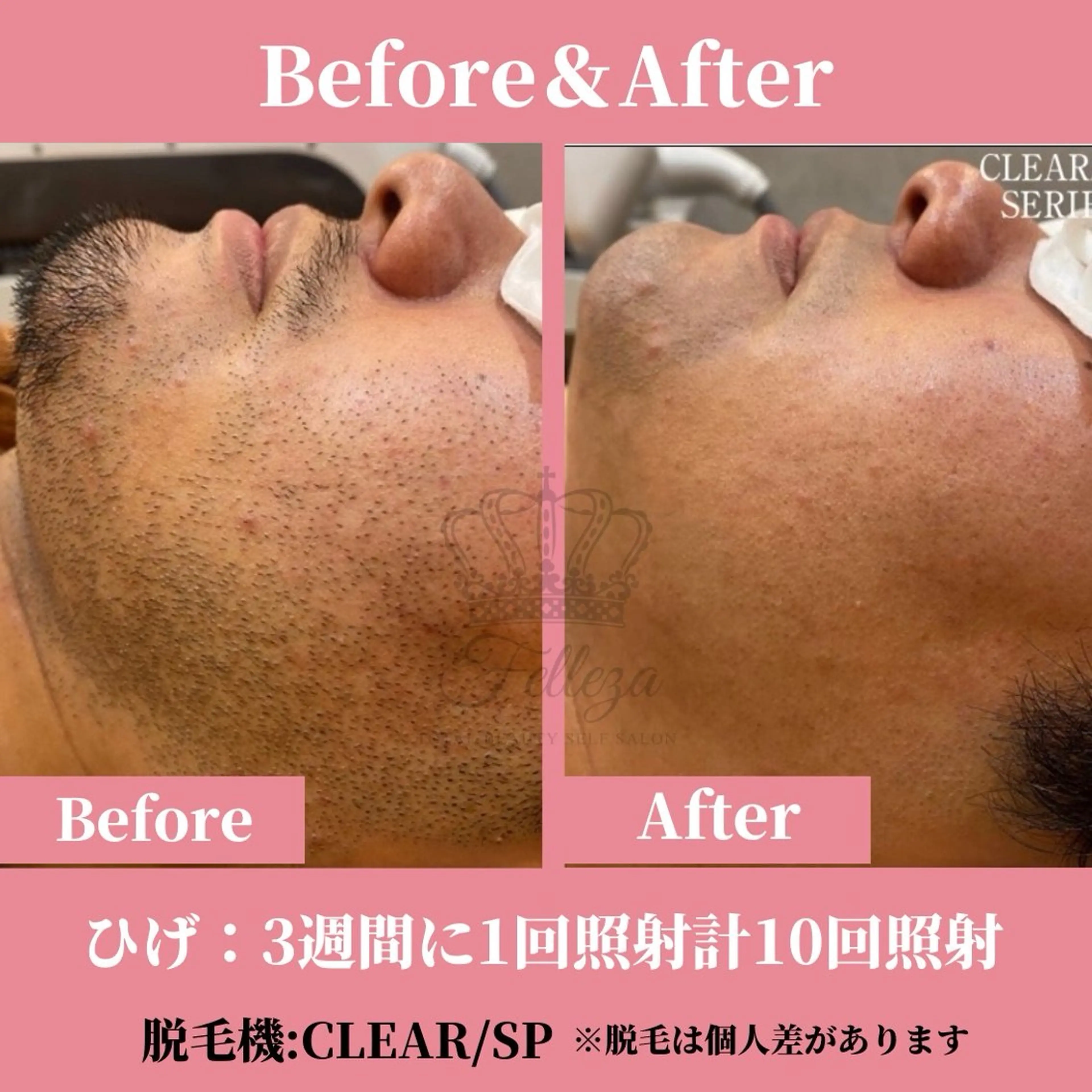 メンズ 有人型セルフサロン 脱毛／痩身／美顔のエステ・リラクイメージ