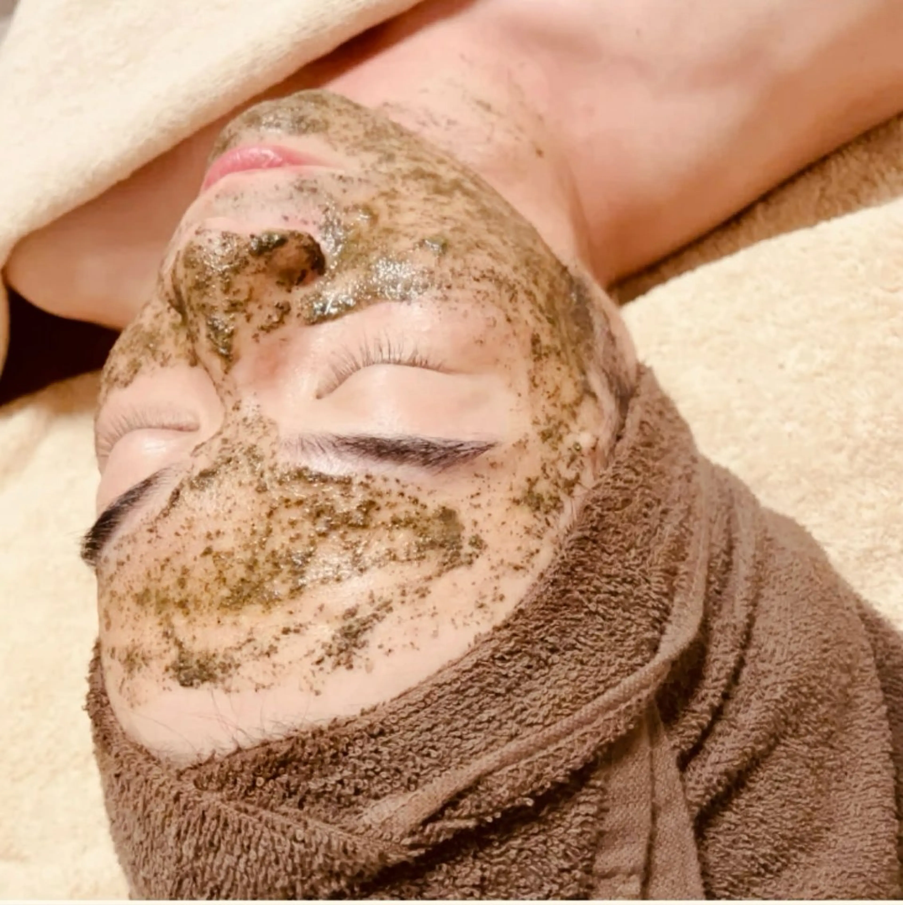 【男性ニキビ】メンズハーブピーリングの写真