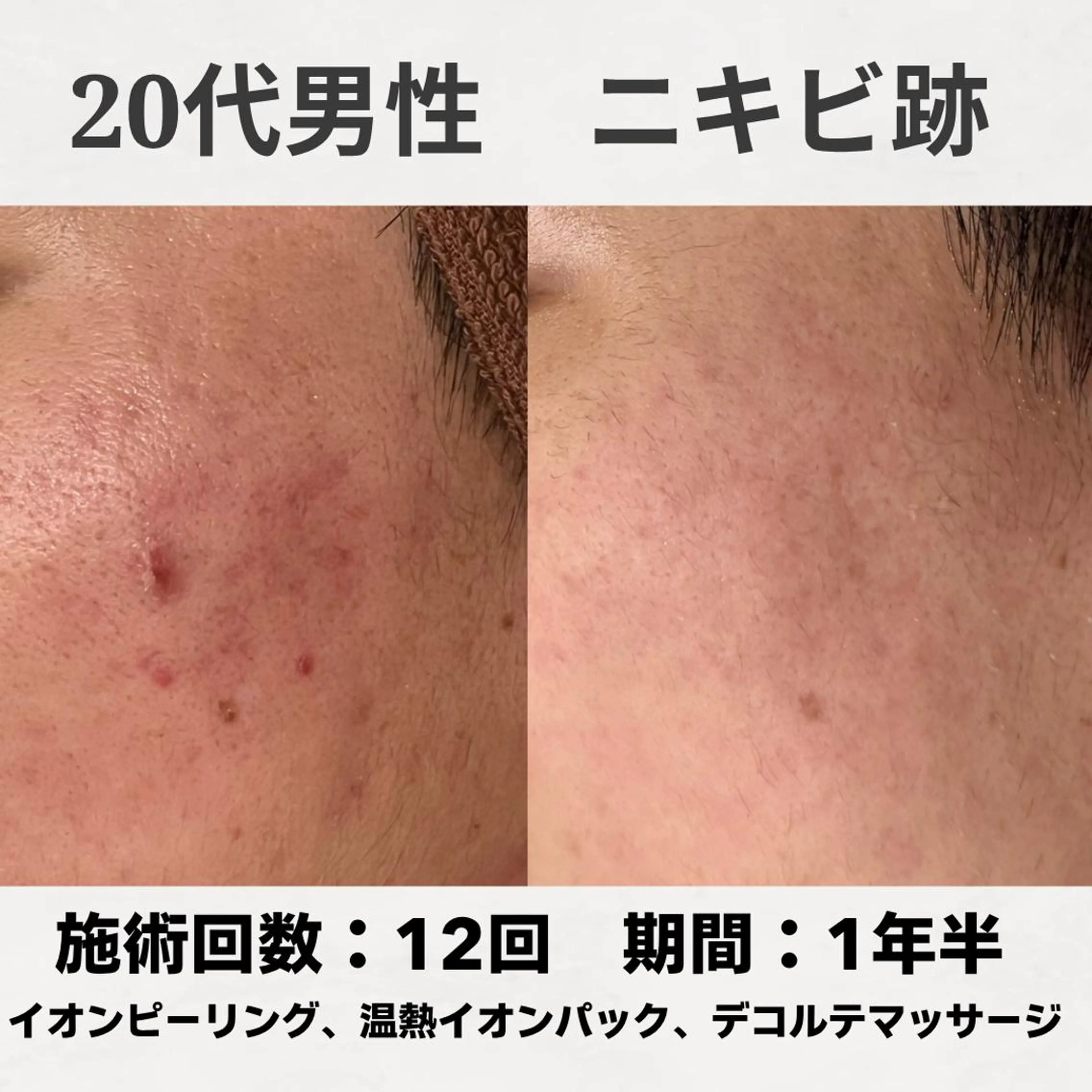 エステ リラク ニキビ跡改善専門🔥 医療にはできない改善のエステ・リラクイメージ