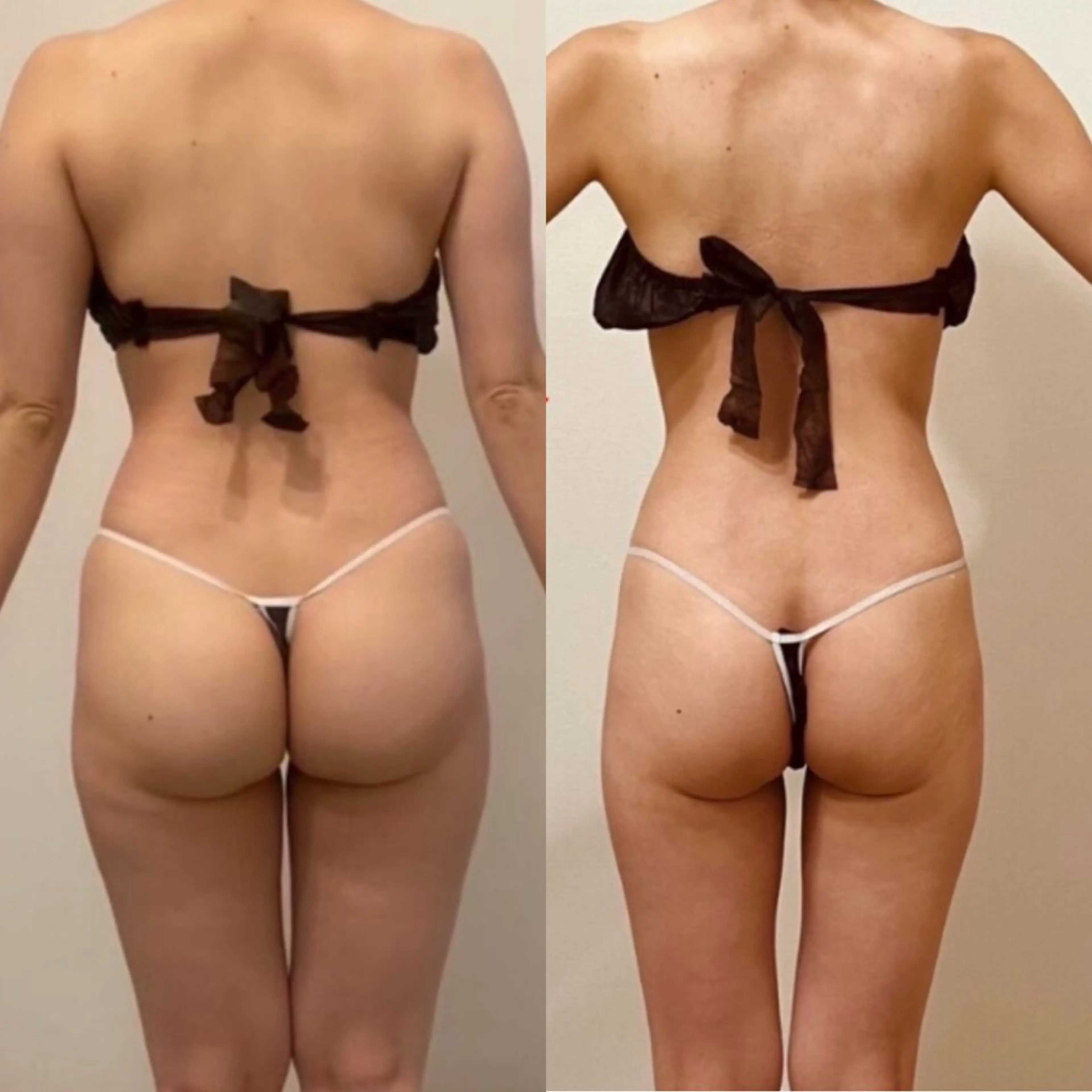 🔥ガリ痩せ🔥キャビ・ラジオ波＋スライドカッピングorEMS・吸引+筋膜ケア90分🌈の写真