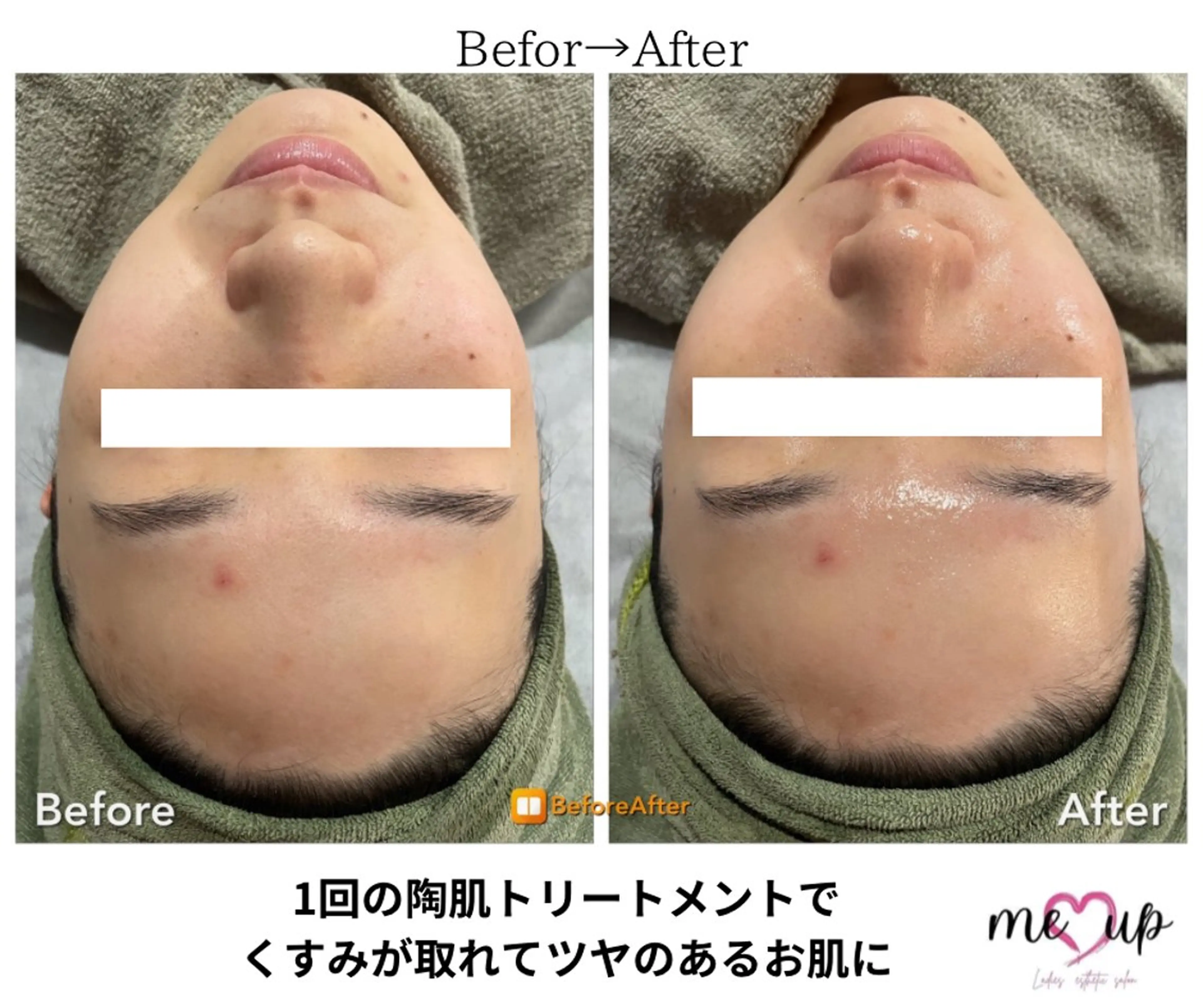 エステ Meupニキビ専門店 背中/ハーブ/肌管理のその他イメージ