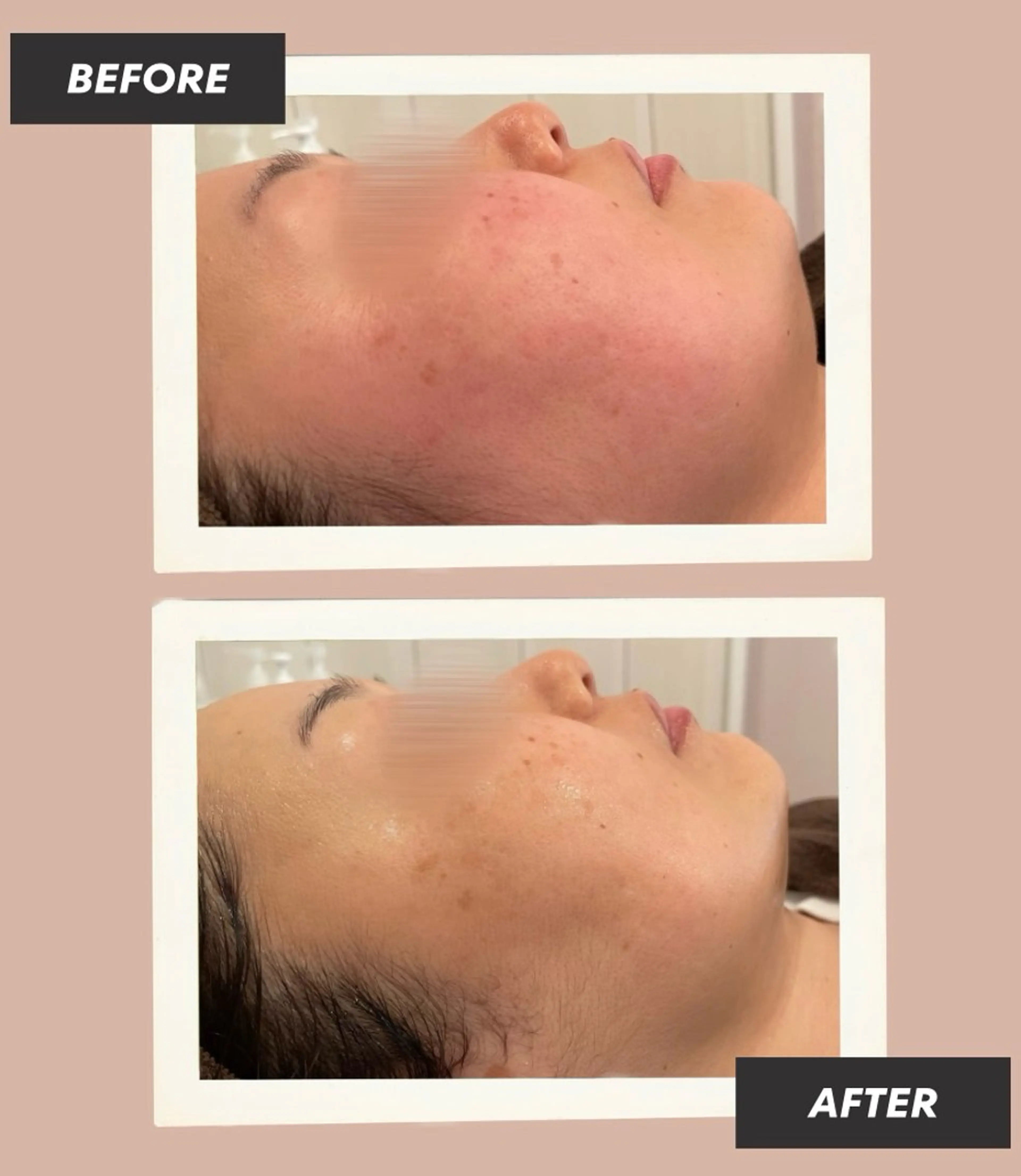 エステ AY'S所属・倉敷/玉島/20代 からの大人毛穴洗浄のエステ・リラクイメージ