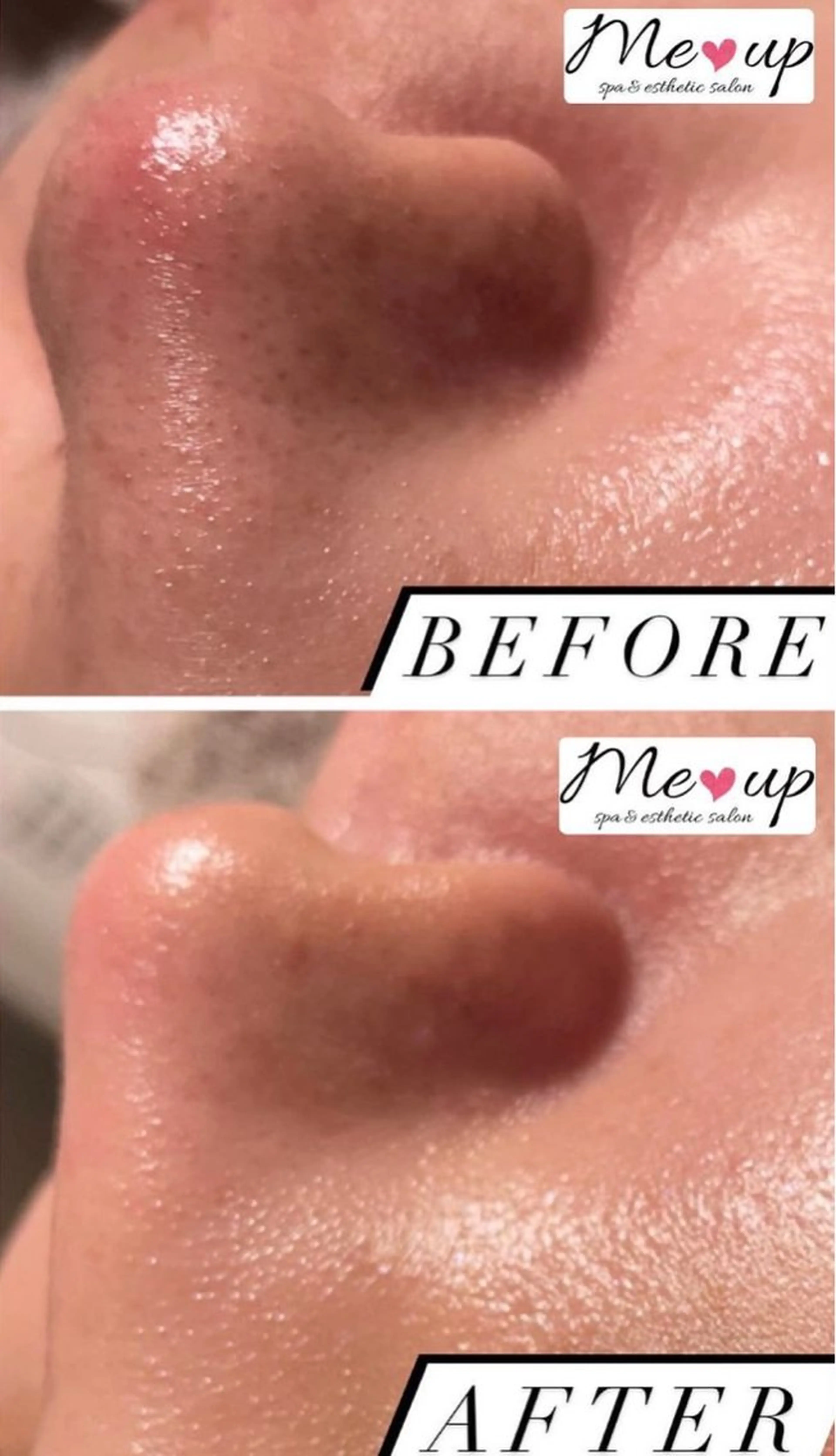 エステ Meupニキビ専門店 背中/ハーブ/肌管理のその他イメージ