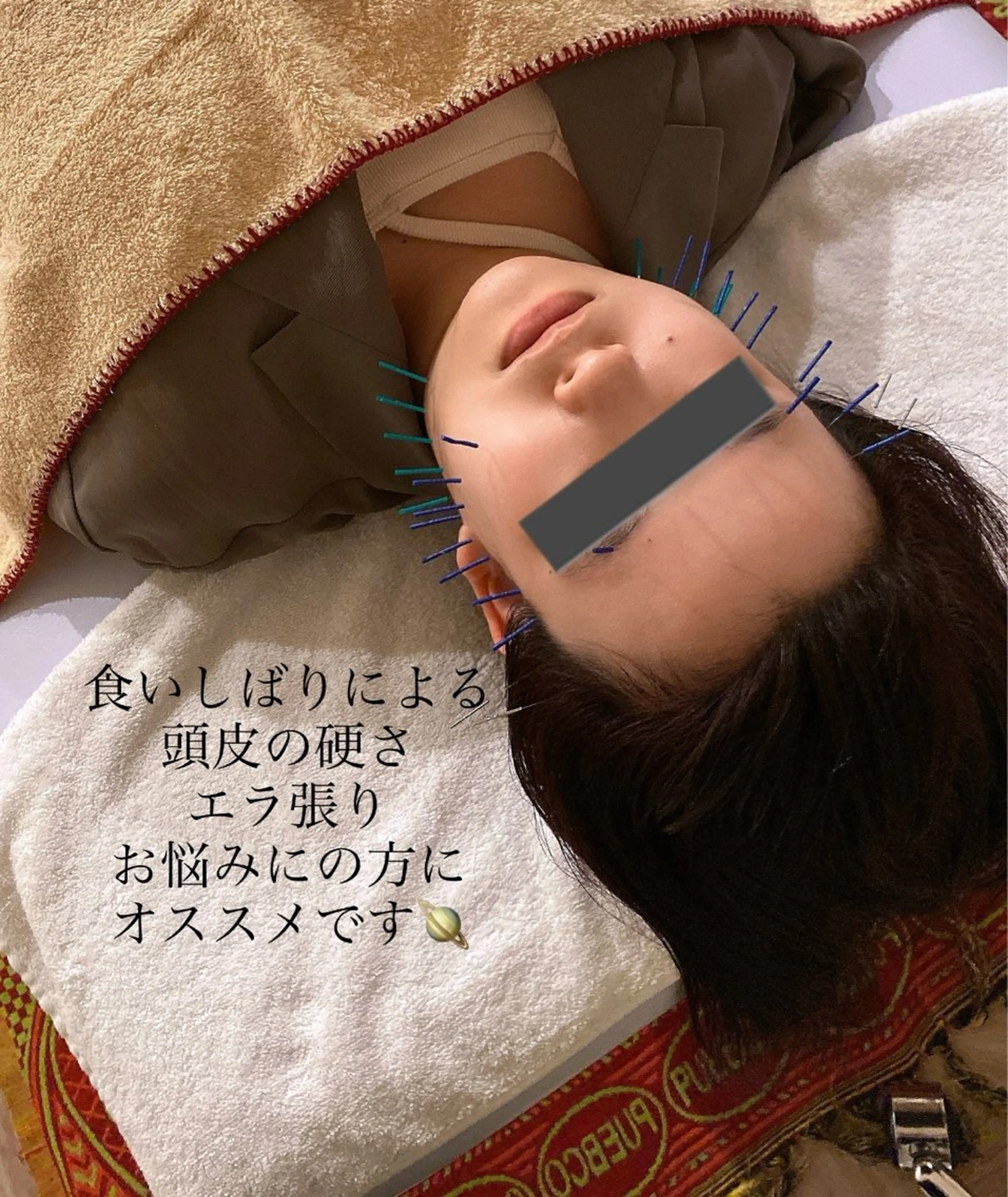 美容鍼/ヘッドスパ/ 💎さかもとのエステ・リラクイメージ