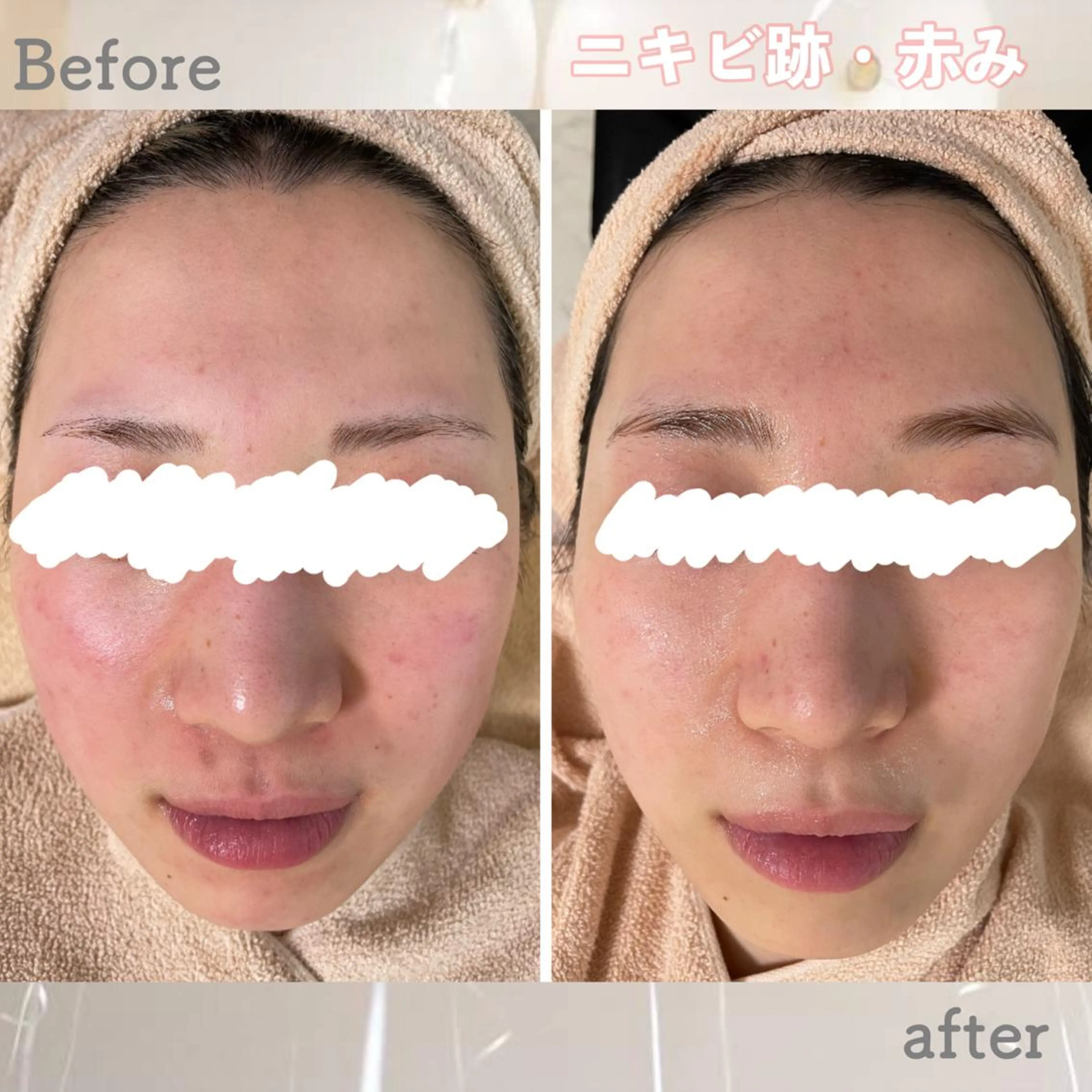 ショート カラー パーマ ヘアアレンジ メンズ キッズ ネイル マツエク・マツパ アイブロウ 赤色 エステ ニキビ&跡改善サロン オーナー光木のエステ・リラクイメージ