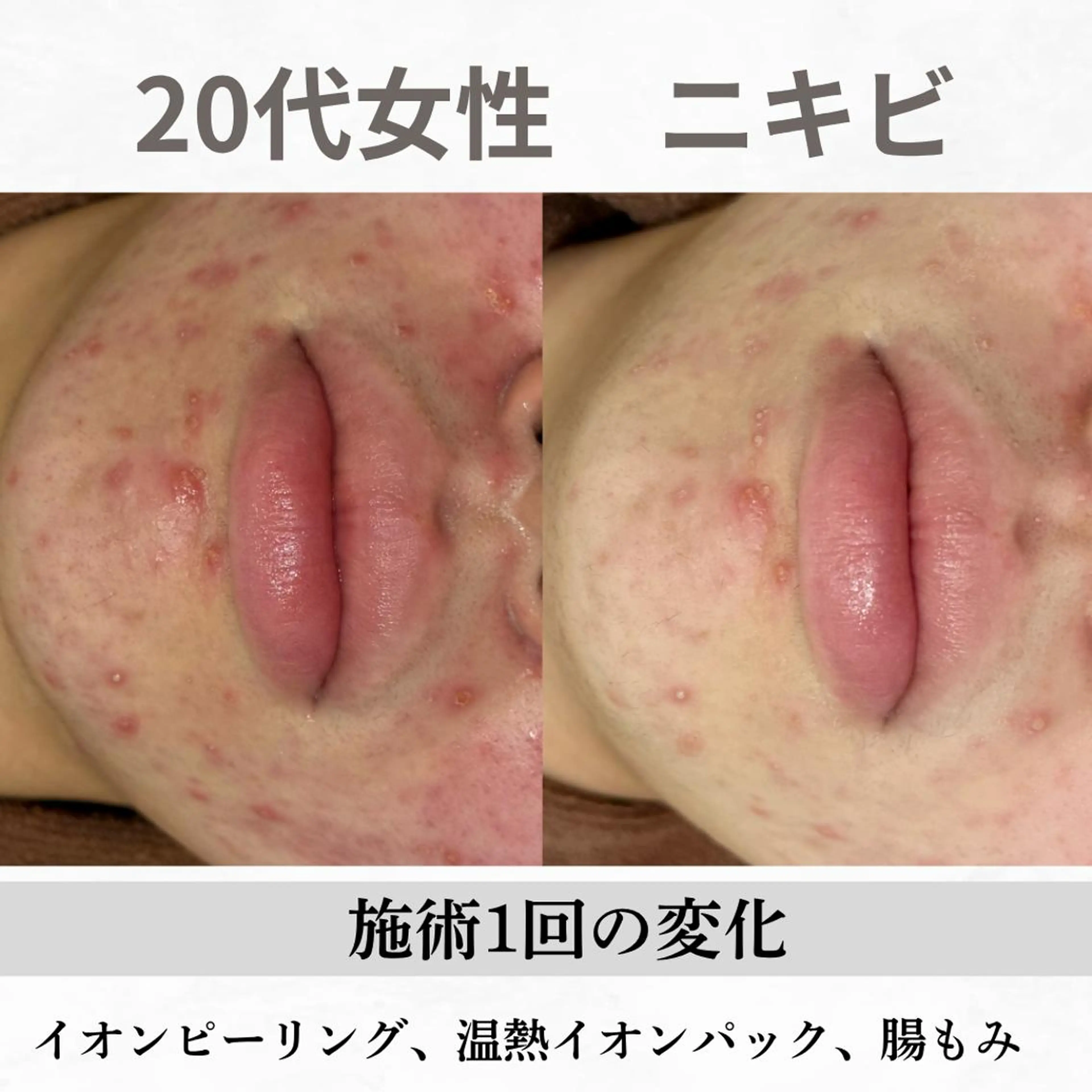 重度ニキビ専門🌷 ダウンタイムなしのエステ・リラクイメージ
