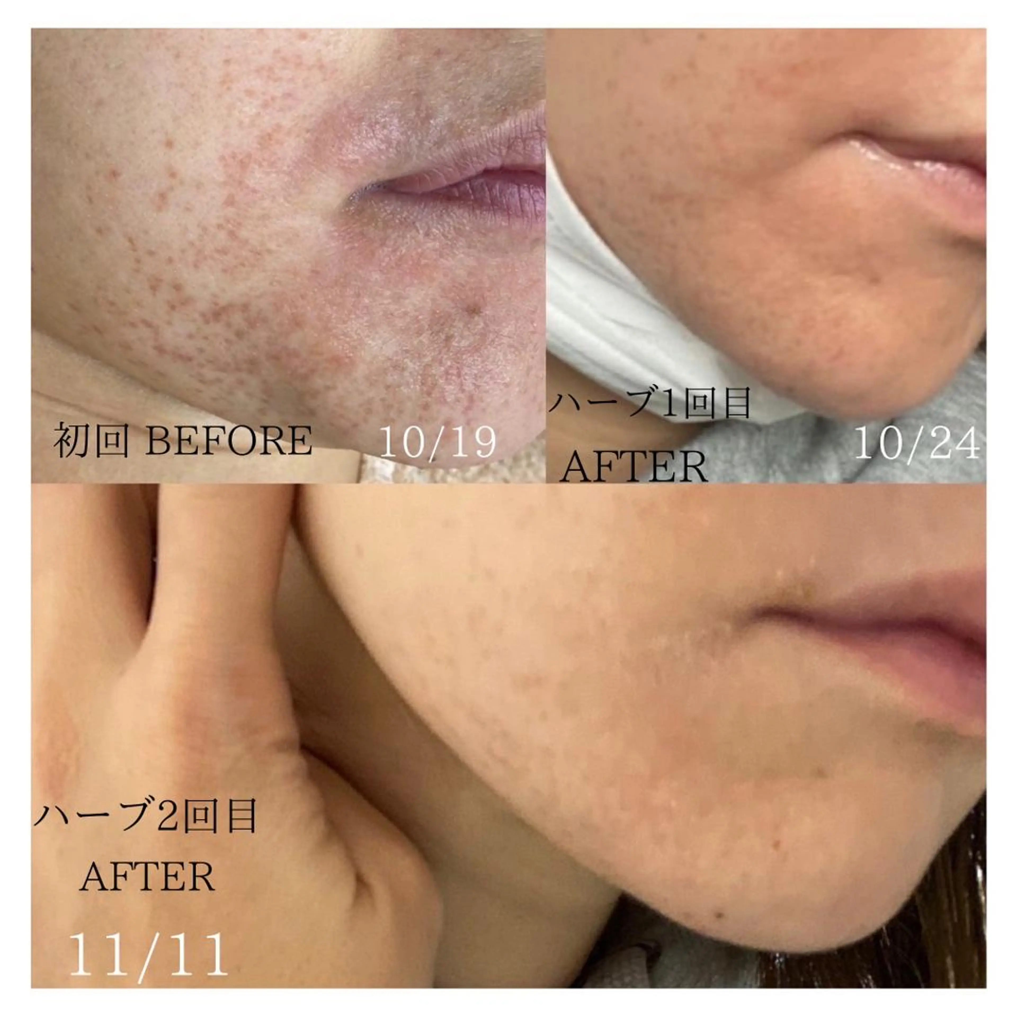 【HAABリプロ】 肌質改善 肌再生ピーリングの写真