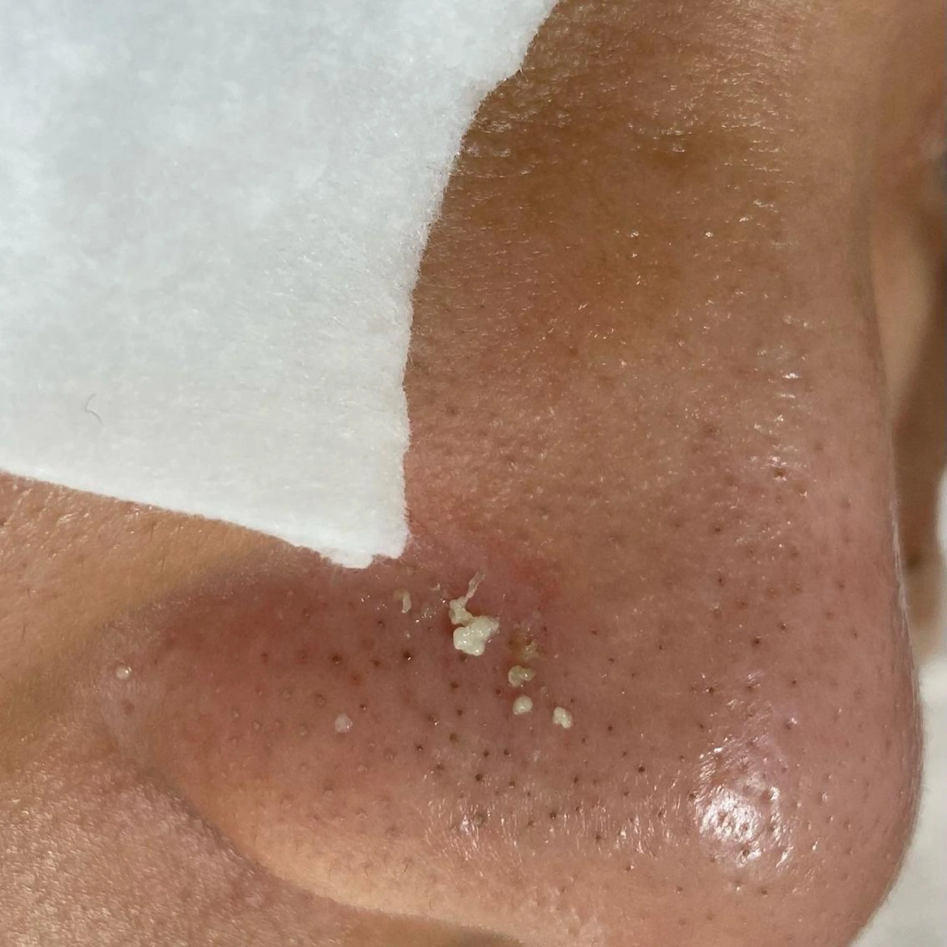 その他 毛穴ケア・肌質改善 徳川のエステ・リラクイメージ