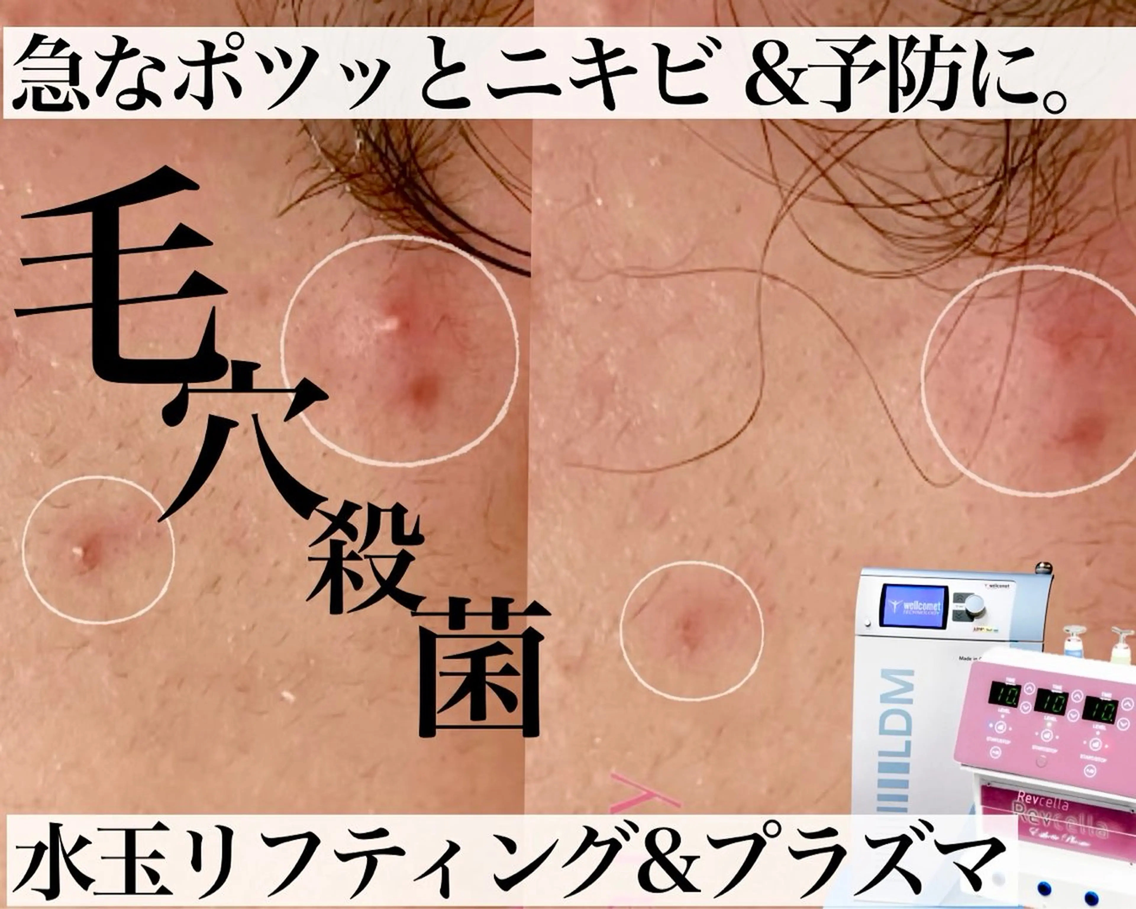 【ニキビ|肌管理】 salon varyのエステ・リラクイメージ