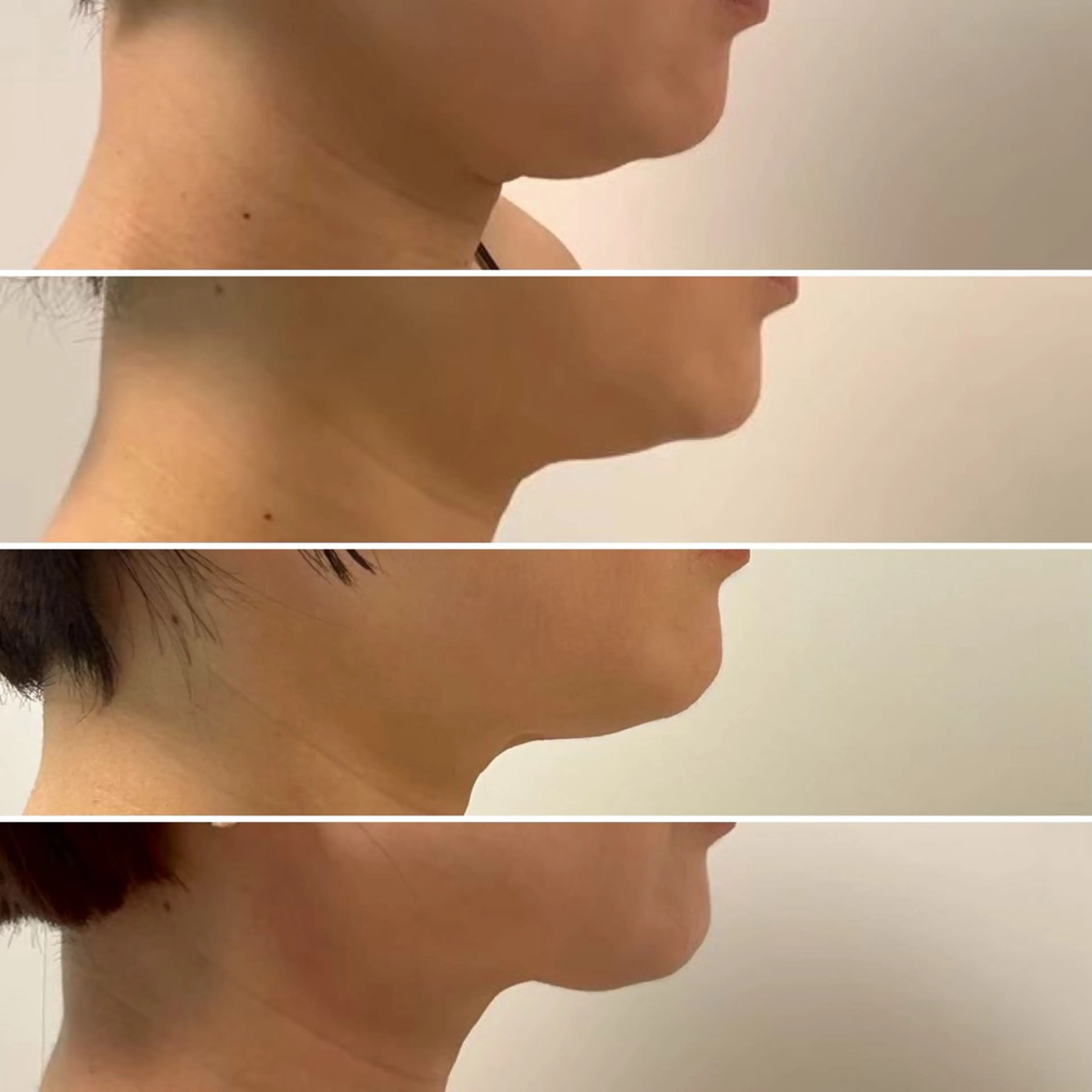 人気No.1二重顎撃退にデコルテリンパマッサージ付🙌リンパを流す事によって、より老廃物が流れ結果が出やすいの写真