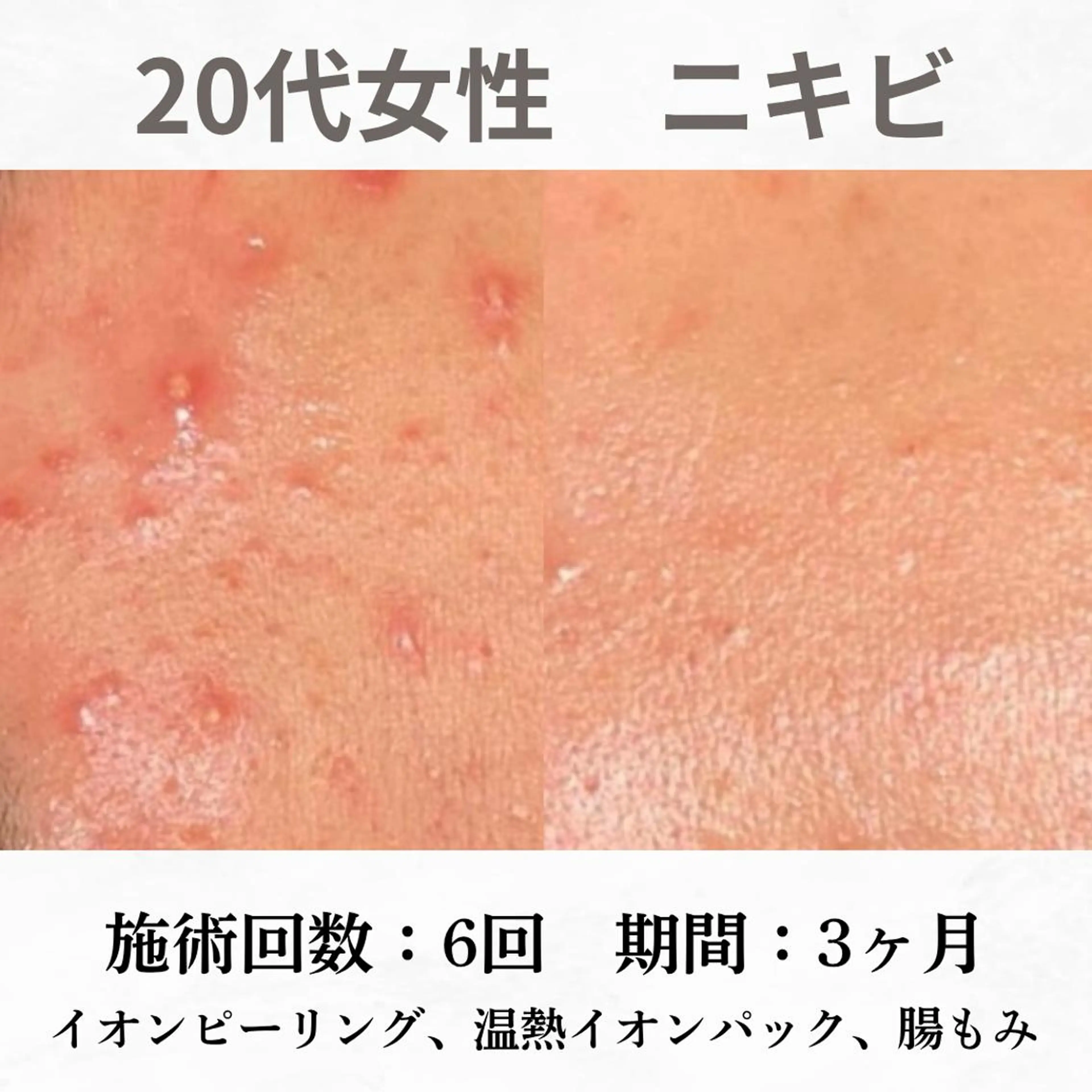 重度ニキビ専門🌷 ダウンタイムなしのエステ・リラクイメージ