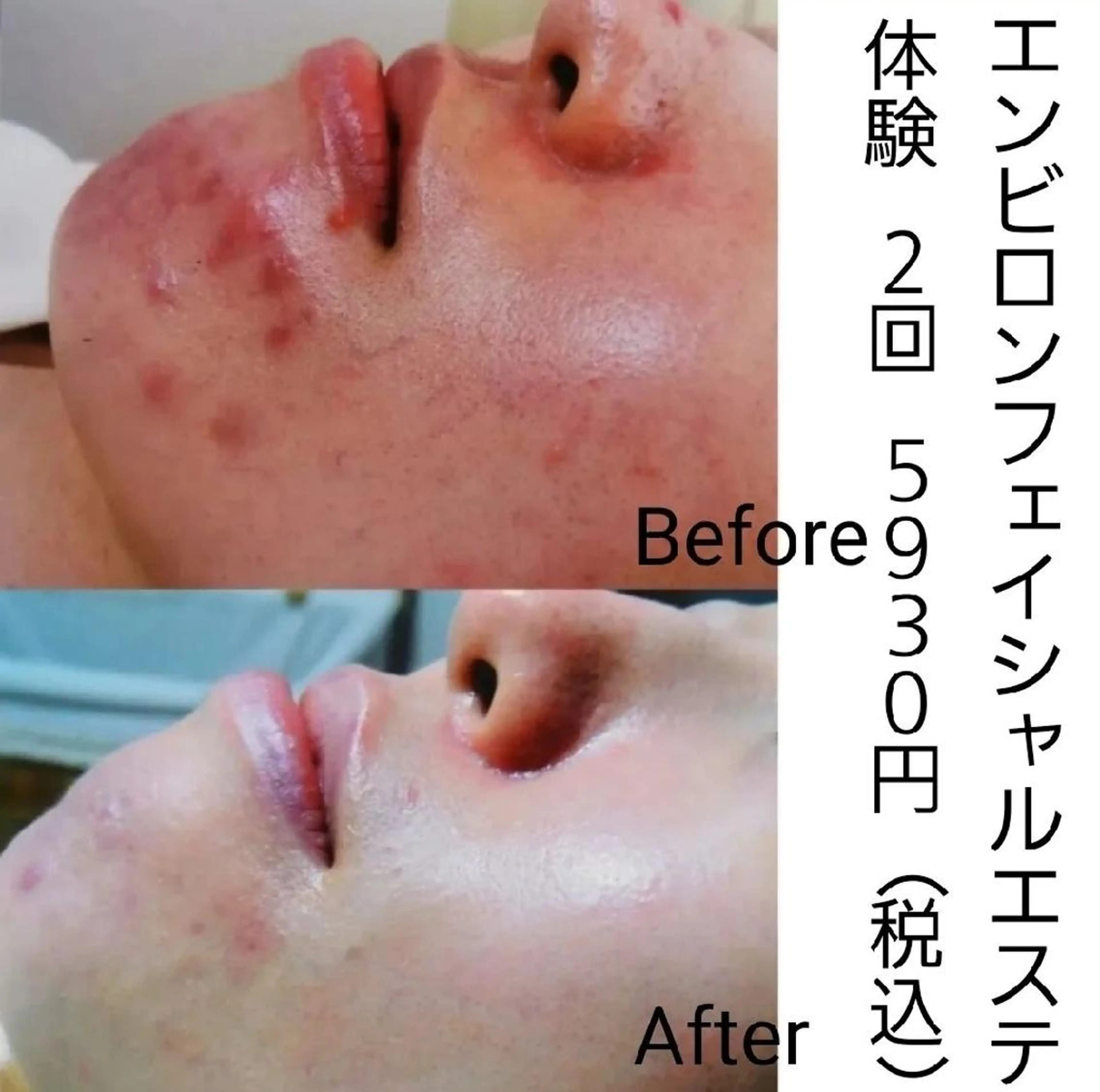 ニキビケア◇ニキビ跡 レゾン京橋店　峠山のエステ・リラクイメージ