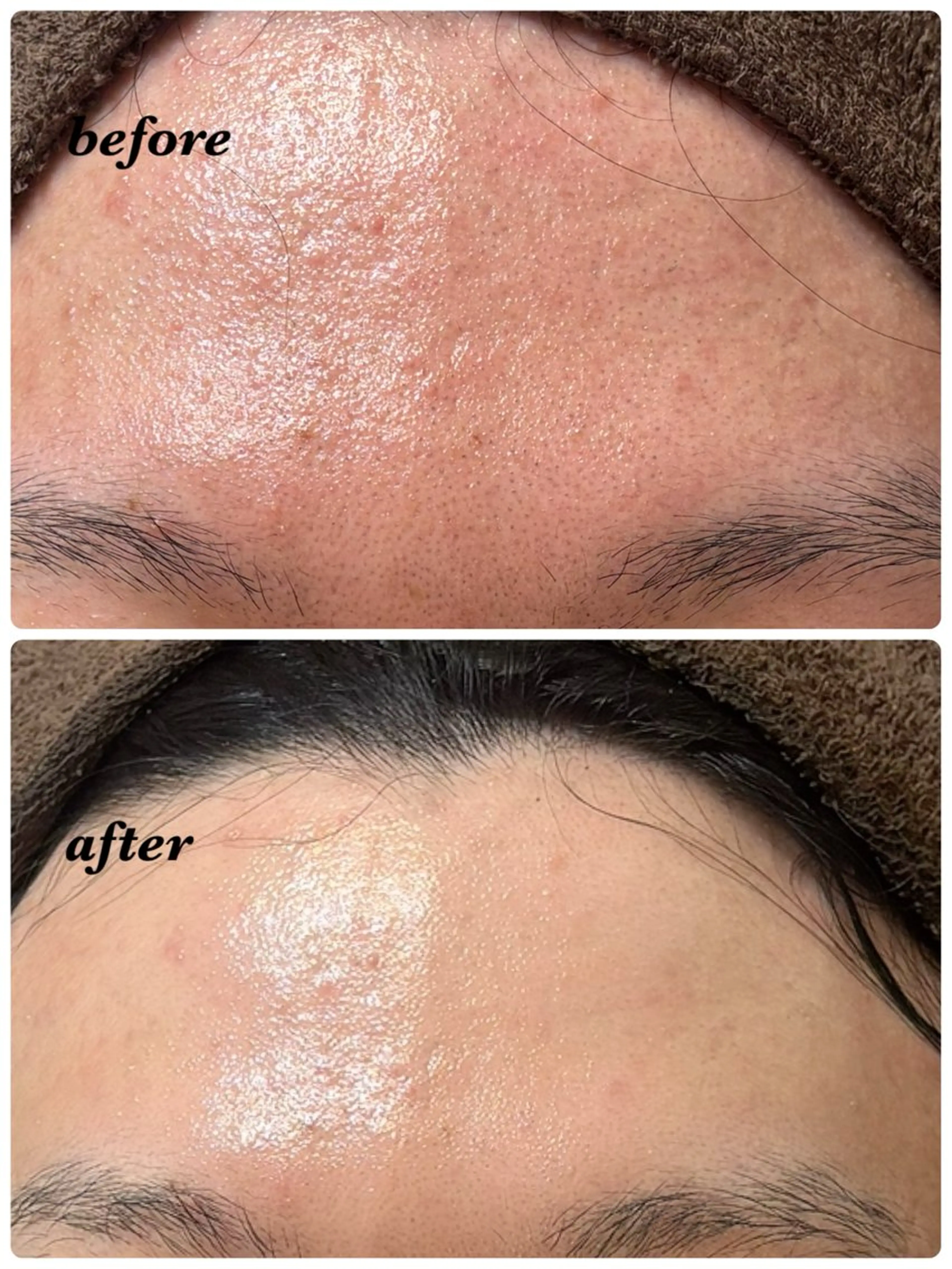 ハーブピーリング専門 毛穴洗浄❤️眉waxのエステ・リラクイメージ