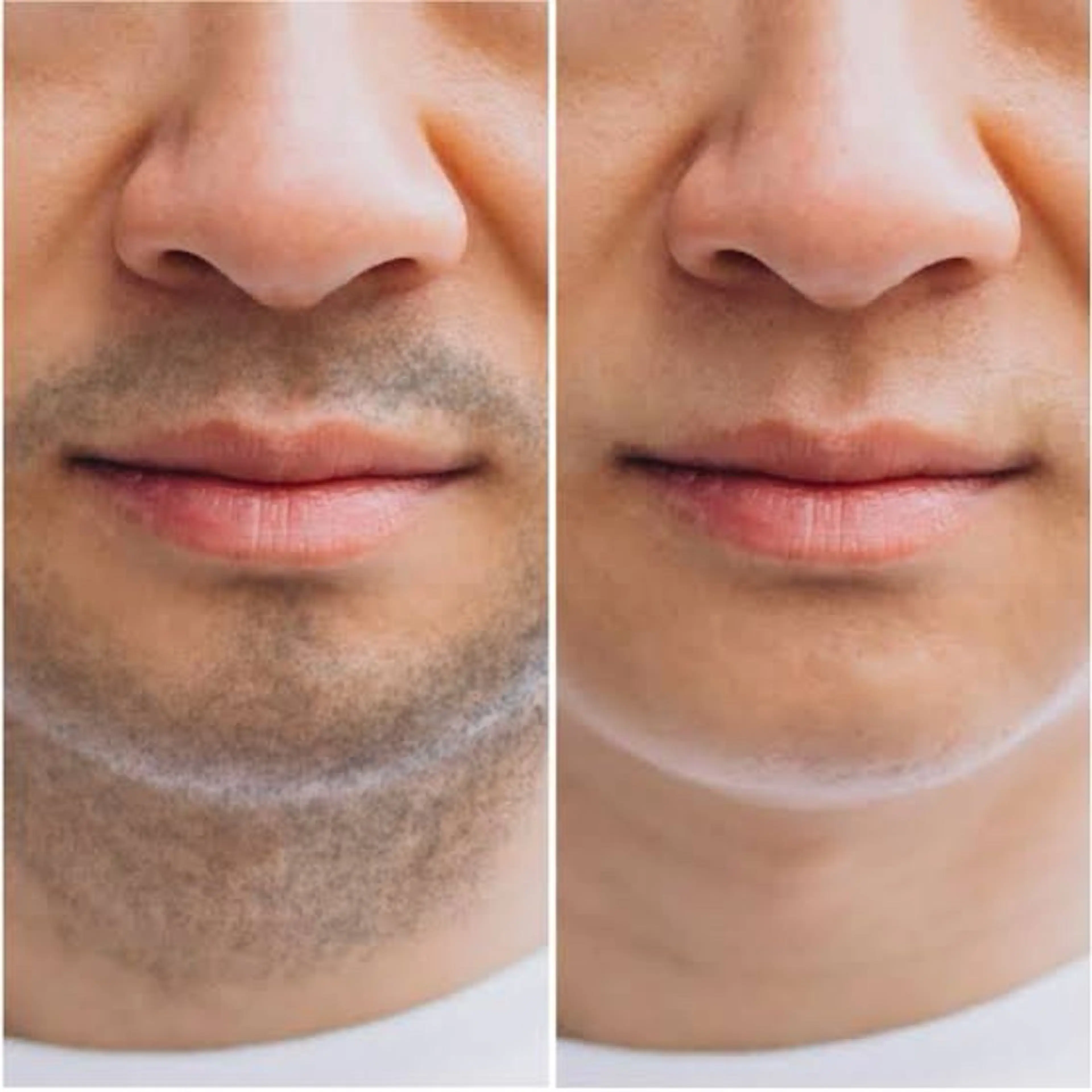 《期間3名様限定》【メンズ】全身脱毛★(VIO除く)の写真