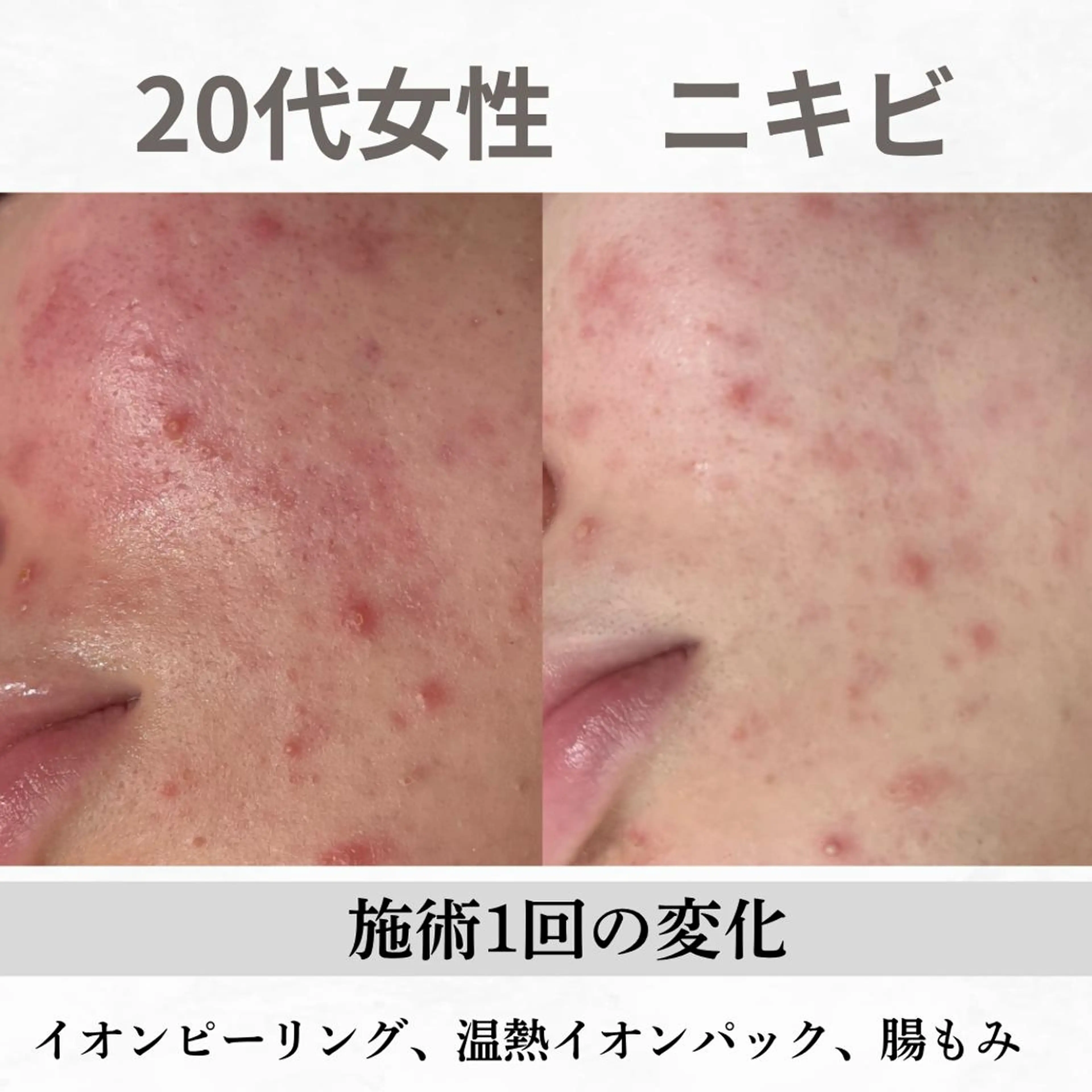 重度ニキビ専門🌷 ダウンタイムなしのエステ・リラクイメージ