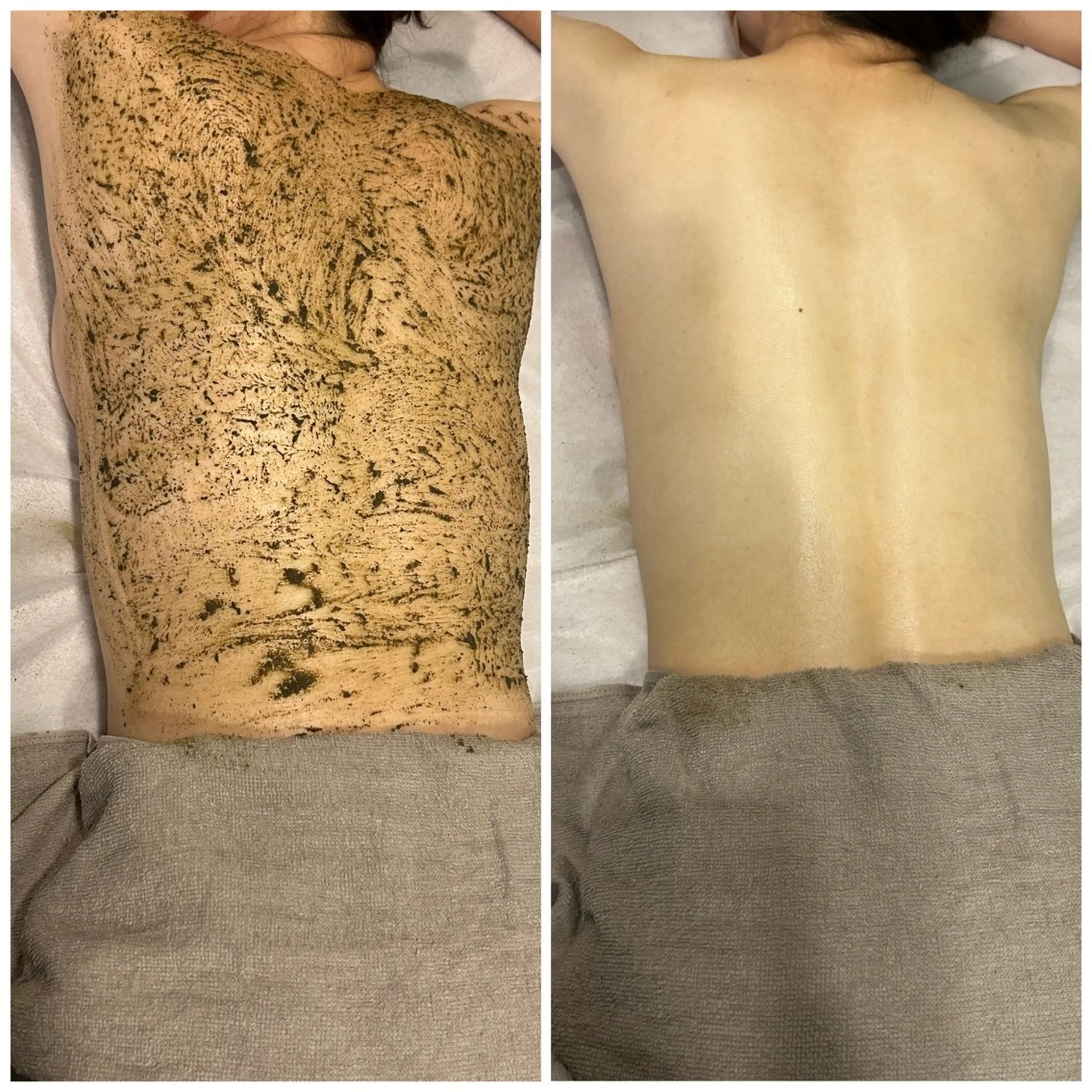 【背中】ハーブピーリングの写真