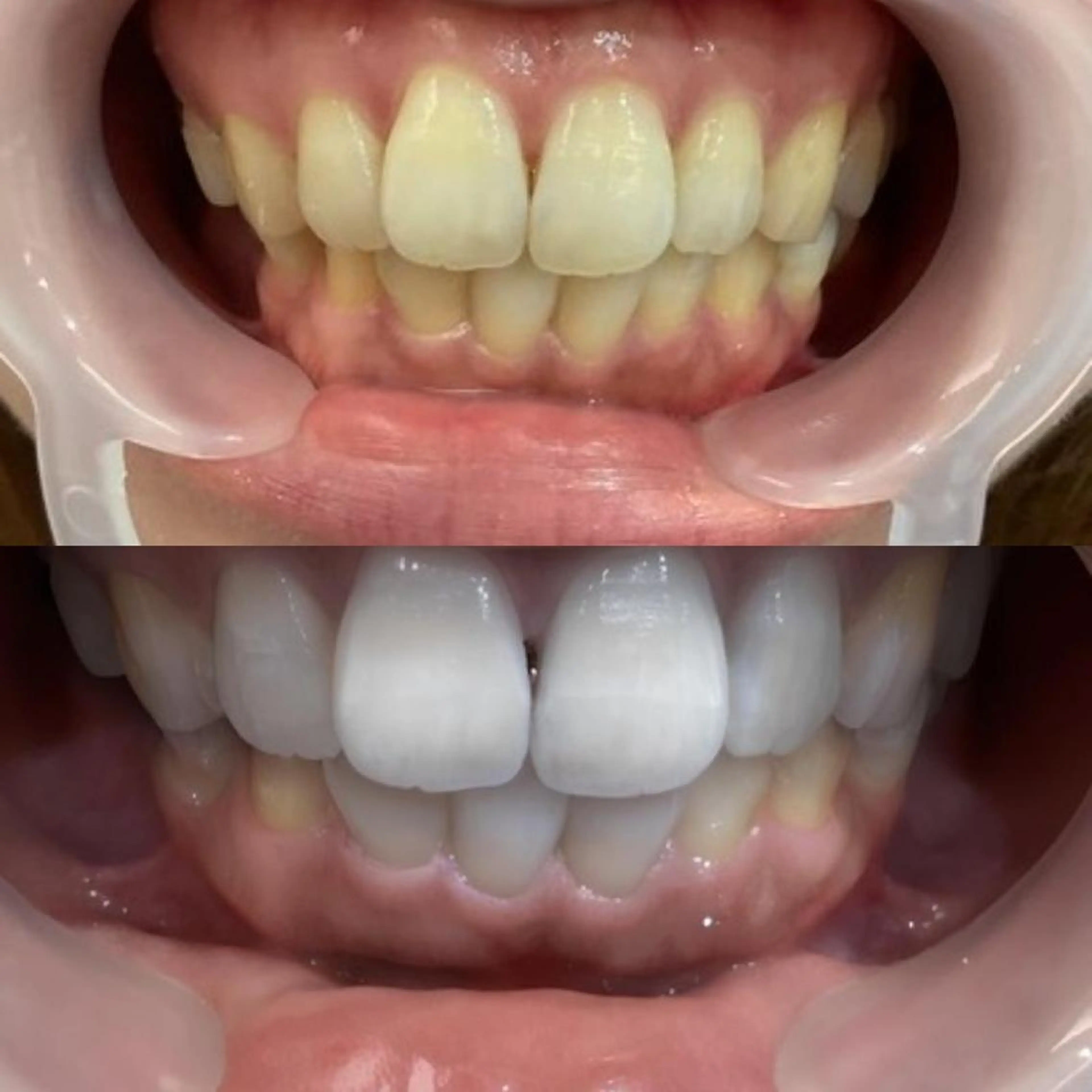 【最強セルフホワイトニング】クリーニング&効果2倍ジェル LED照射15分×2回 ¥7000の写真