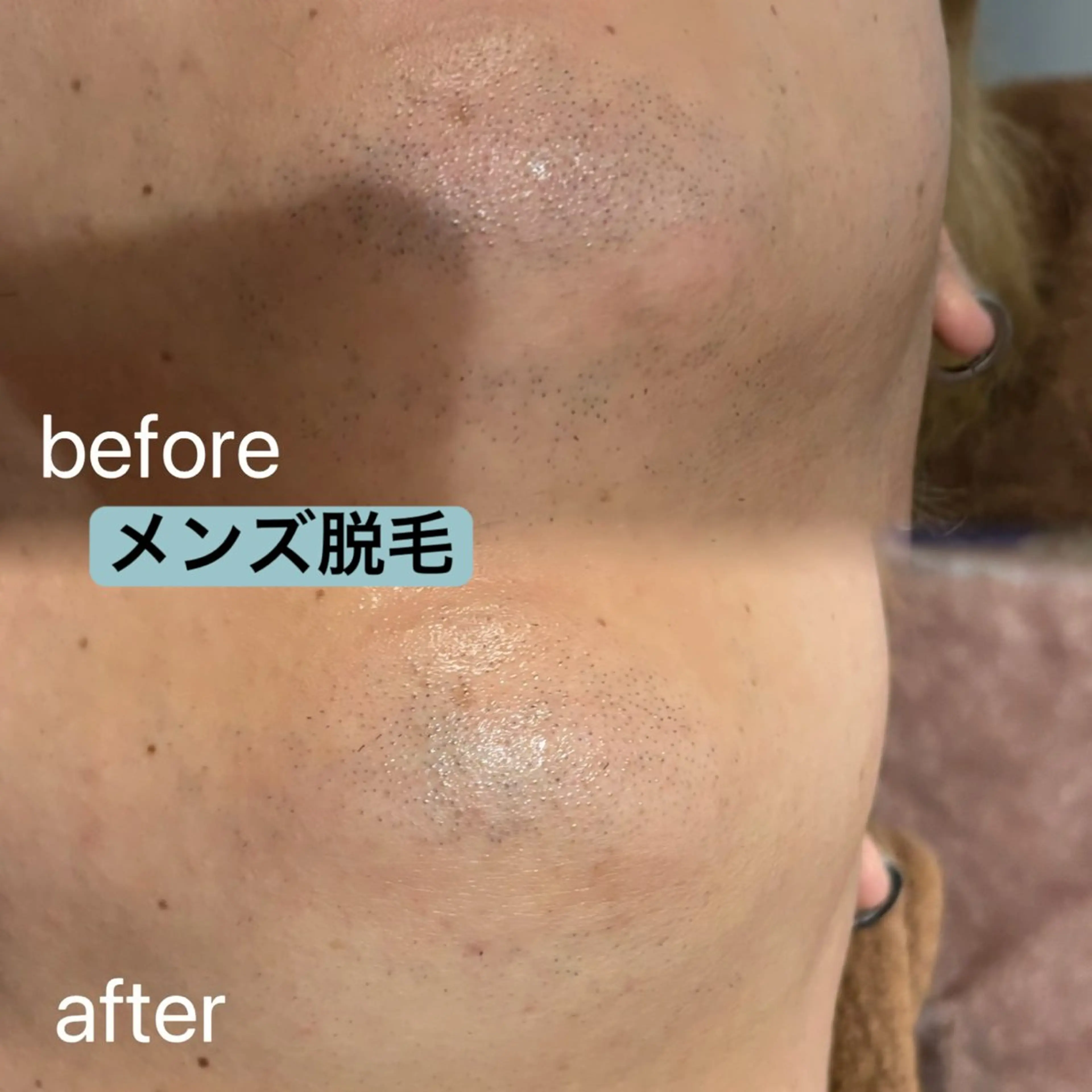 メンズヒゲ脱毛の写真