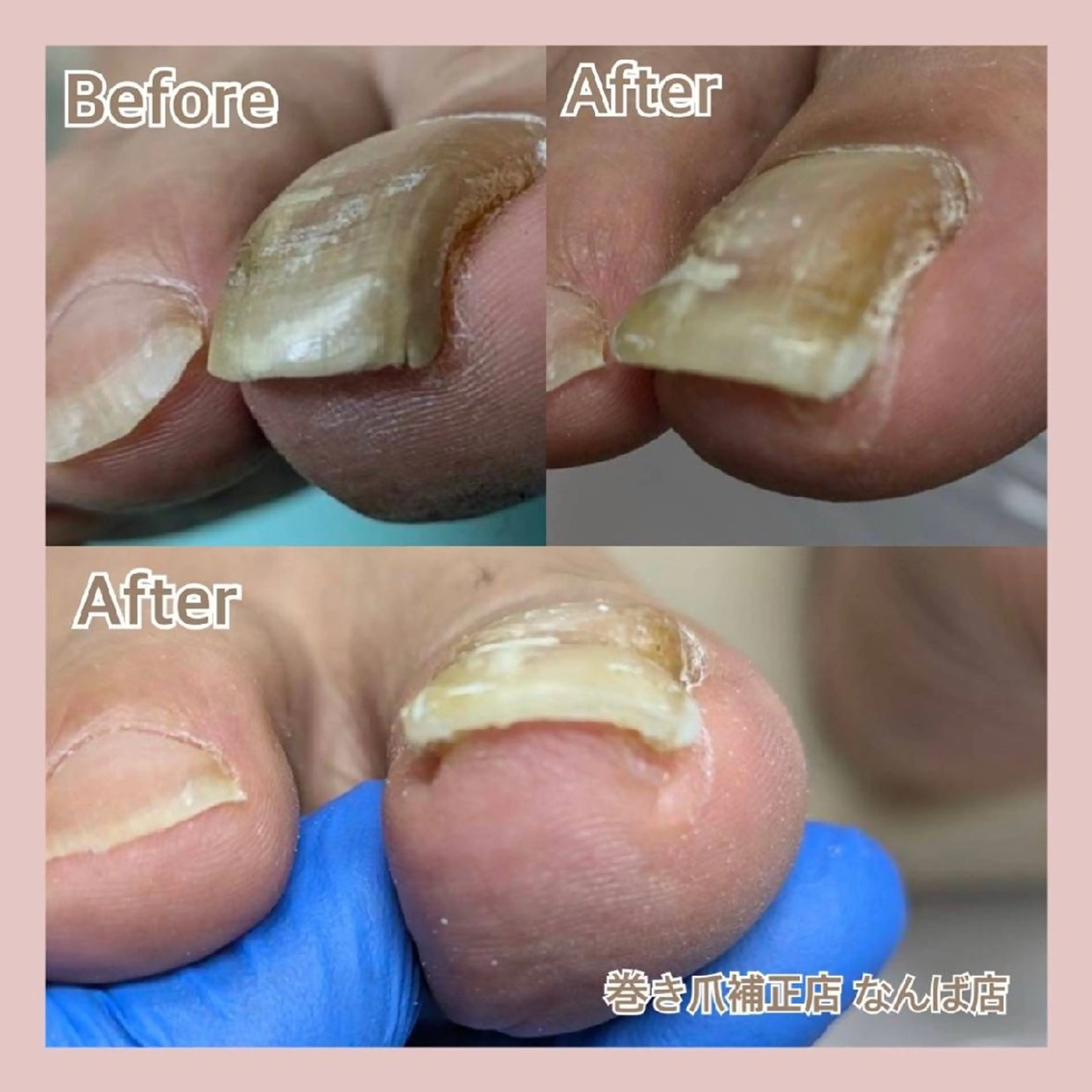 巻き爪補正店 大阪なんば店のネイルデザイン