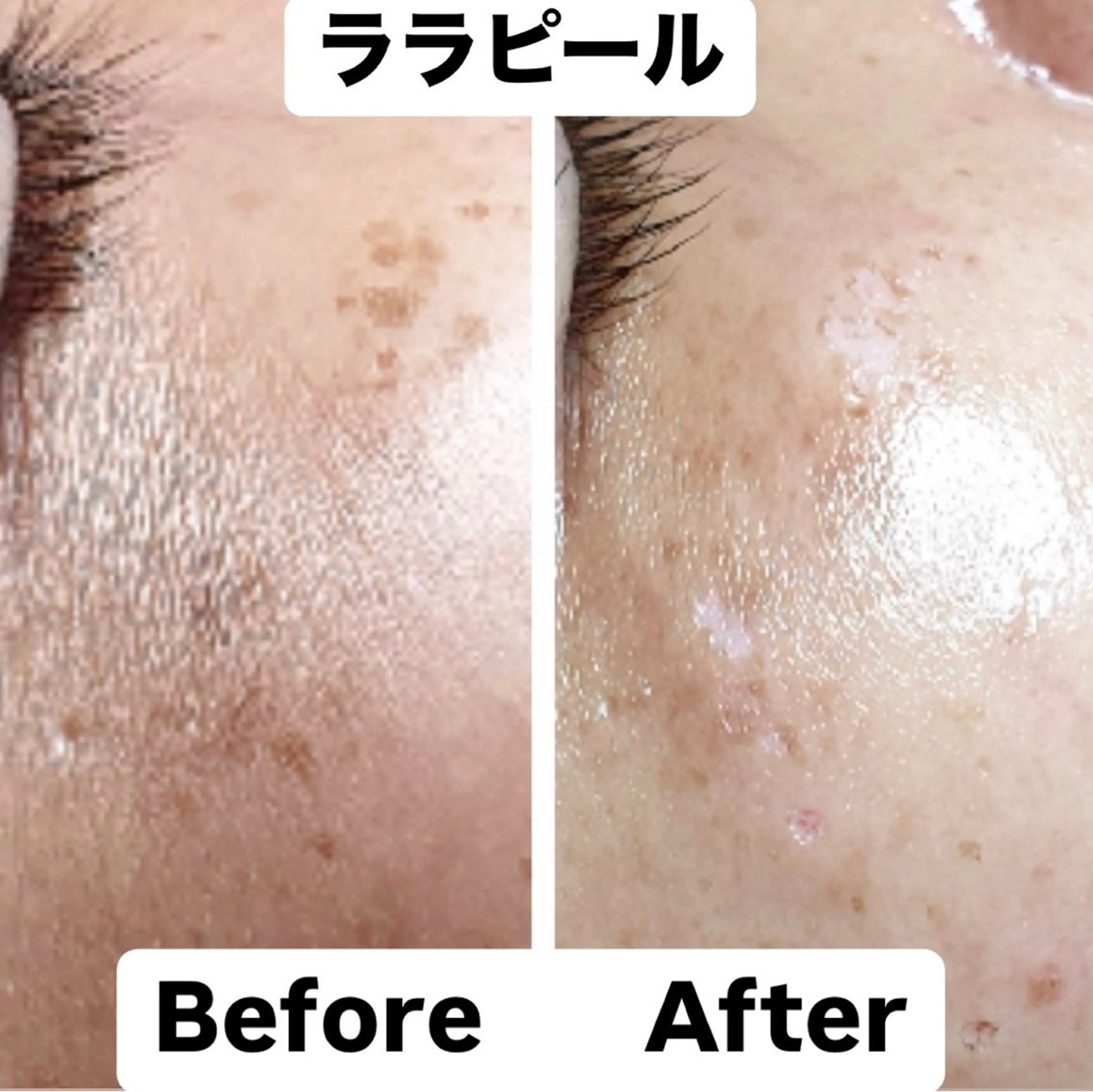 【毛穴レス×艶肌】ララピール【顔+首】+デコルテケア✨LDM導入&幹細胞パック付の写真