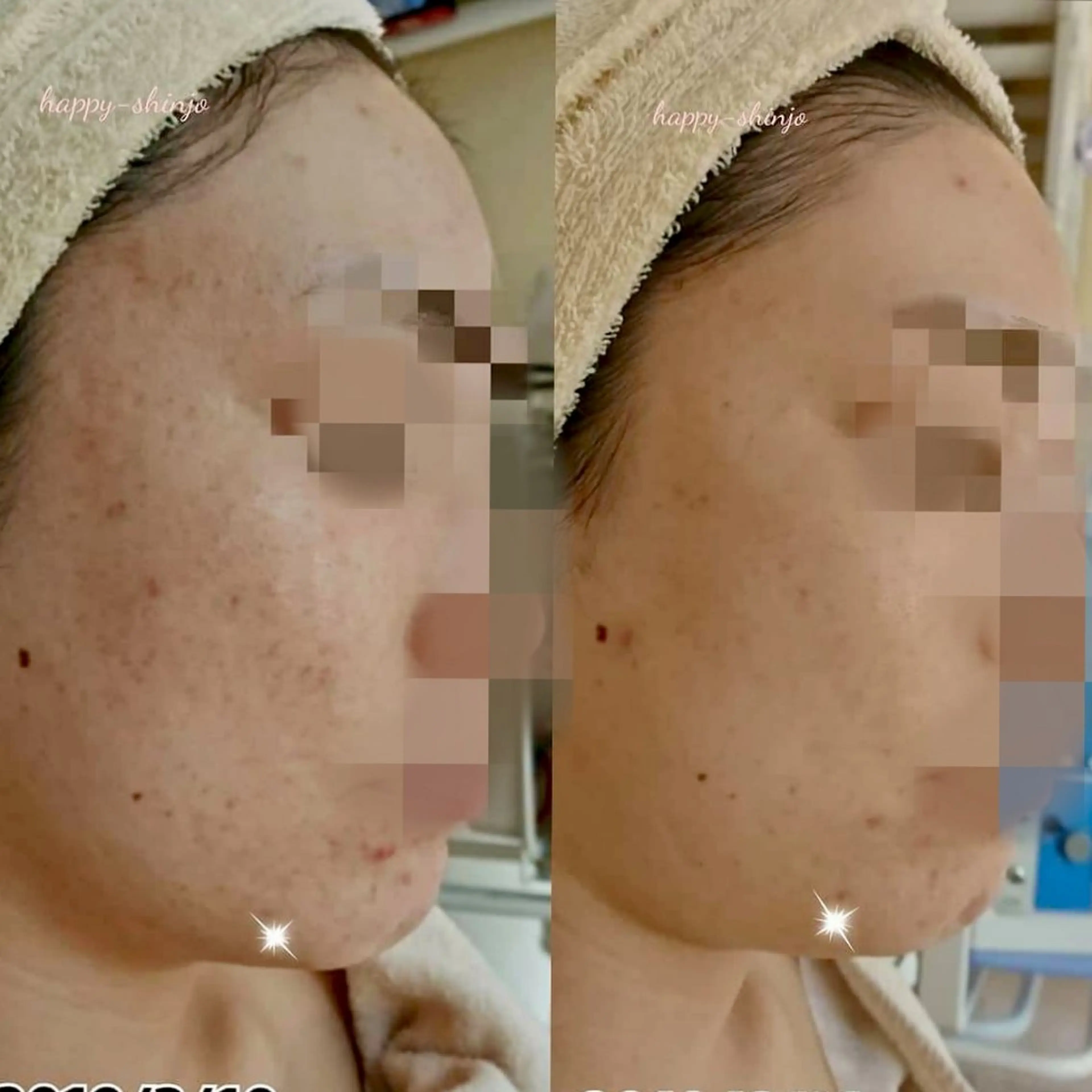 【できた跡&肌の凹み】なめらかつや肌に！ニキビ跡ケア フェイシャルの写真