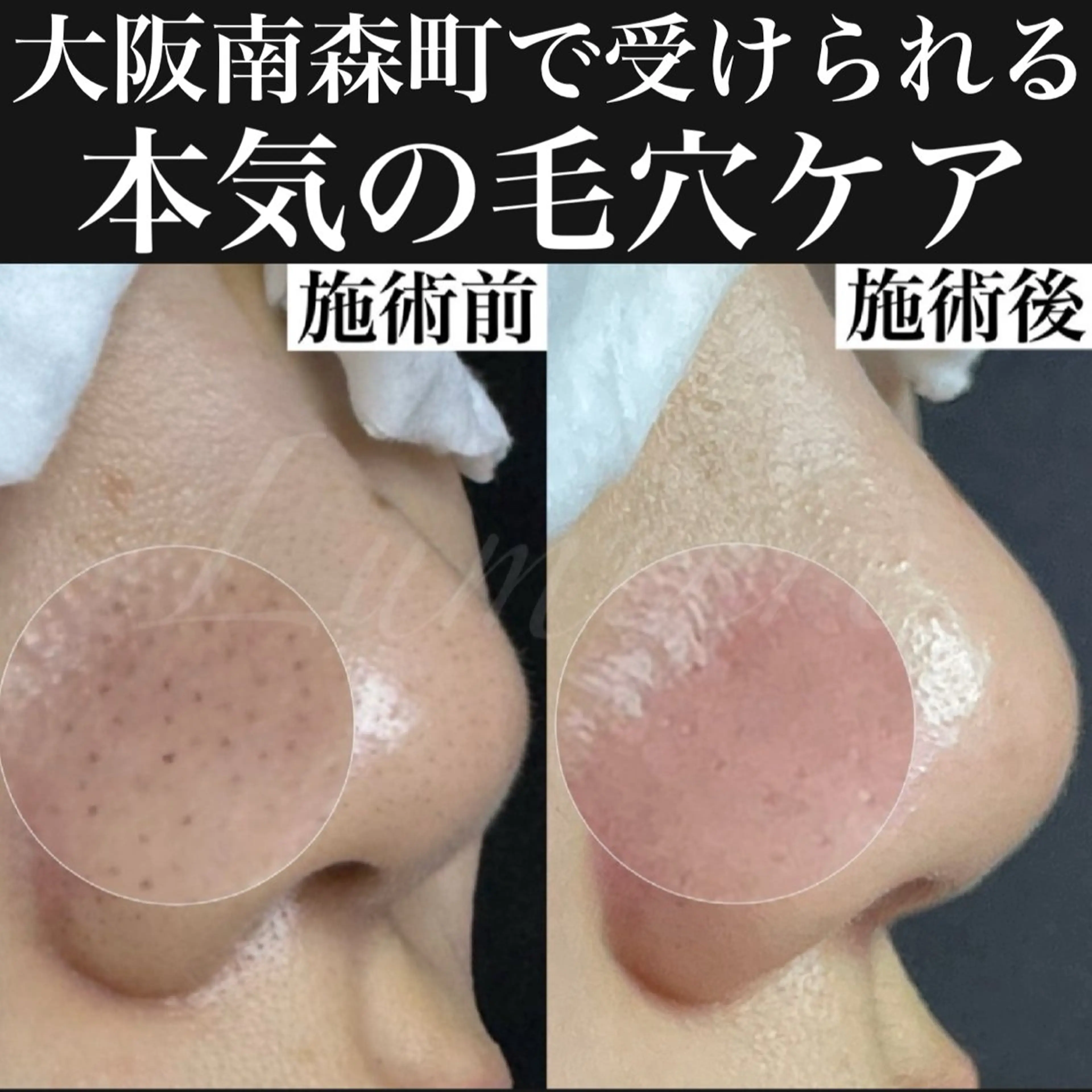 【初回限定90分の毛穴ケア】エクストラクションで毛穴改善！黒ずみ・ザラつき撃退！南森町駅徒歩5分✨の写真