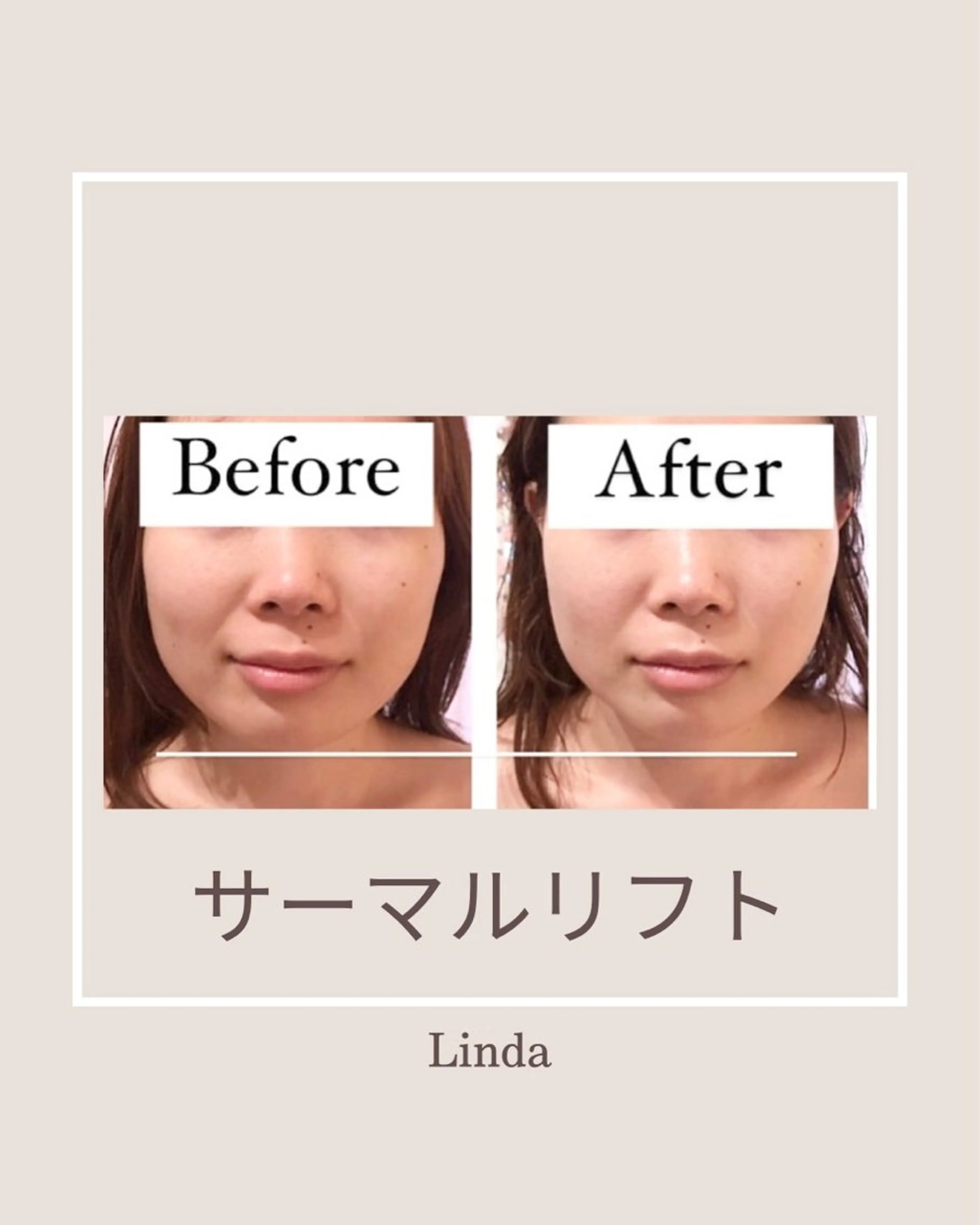 エステ 小顔&毛穴・肌質改善 LINDA西宮 AIのエステ・リラクイメージ