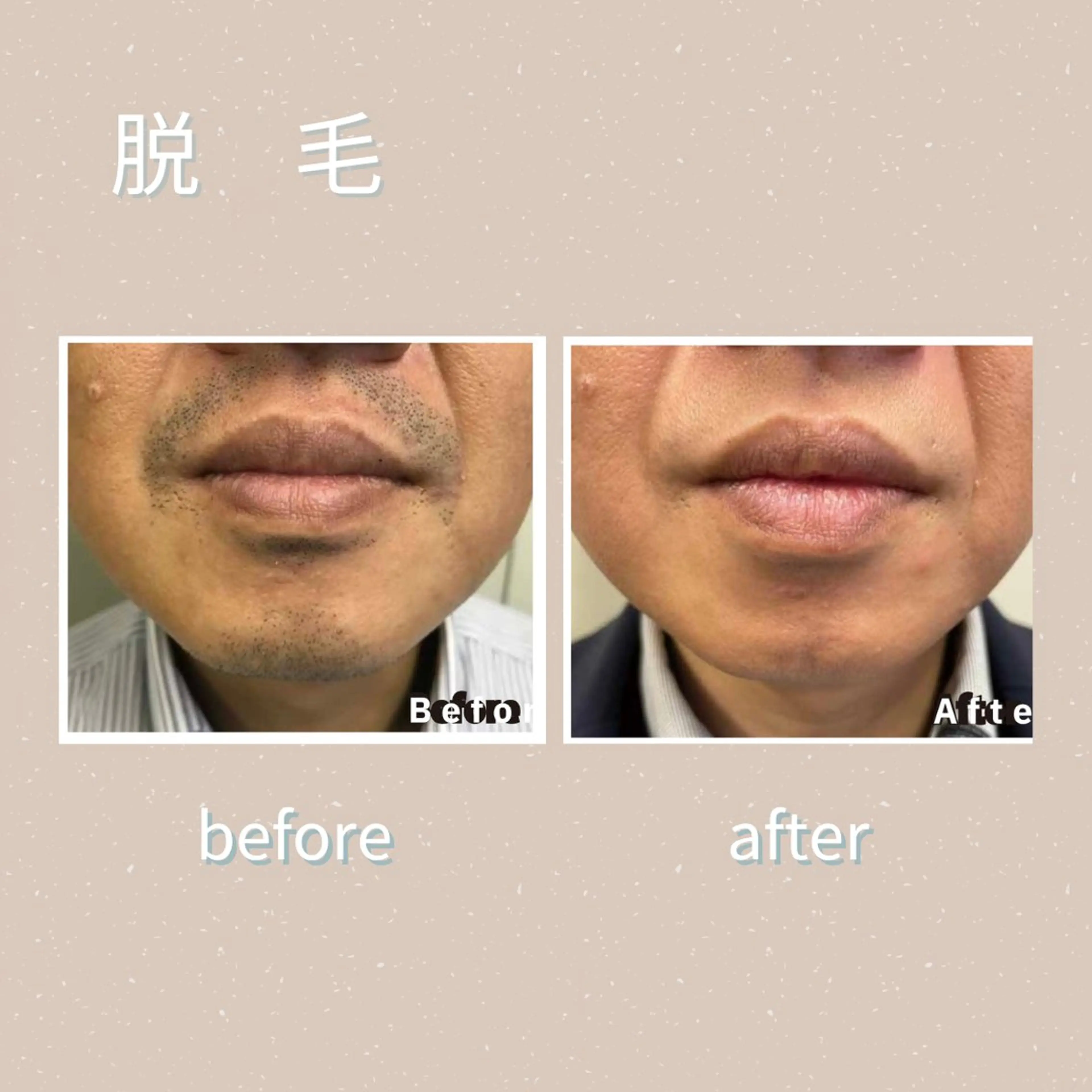 ヒゲ脱毛の写真