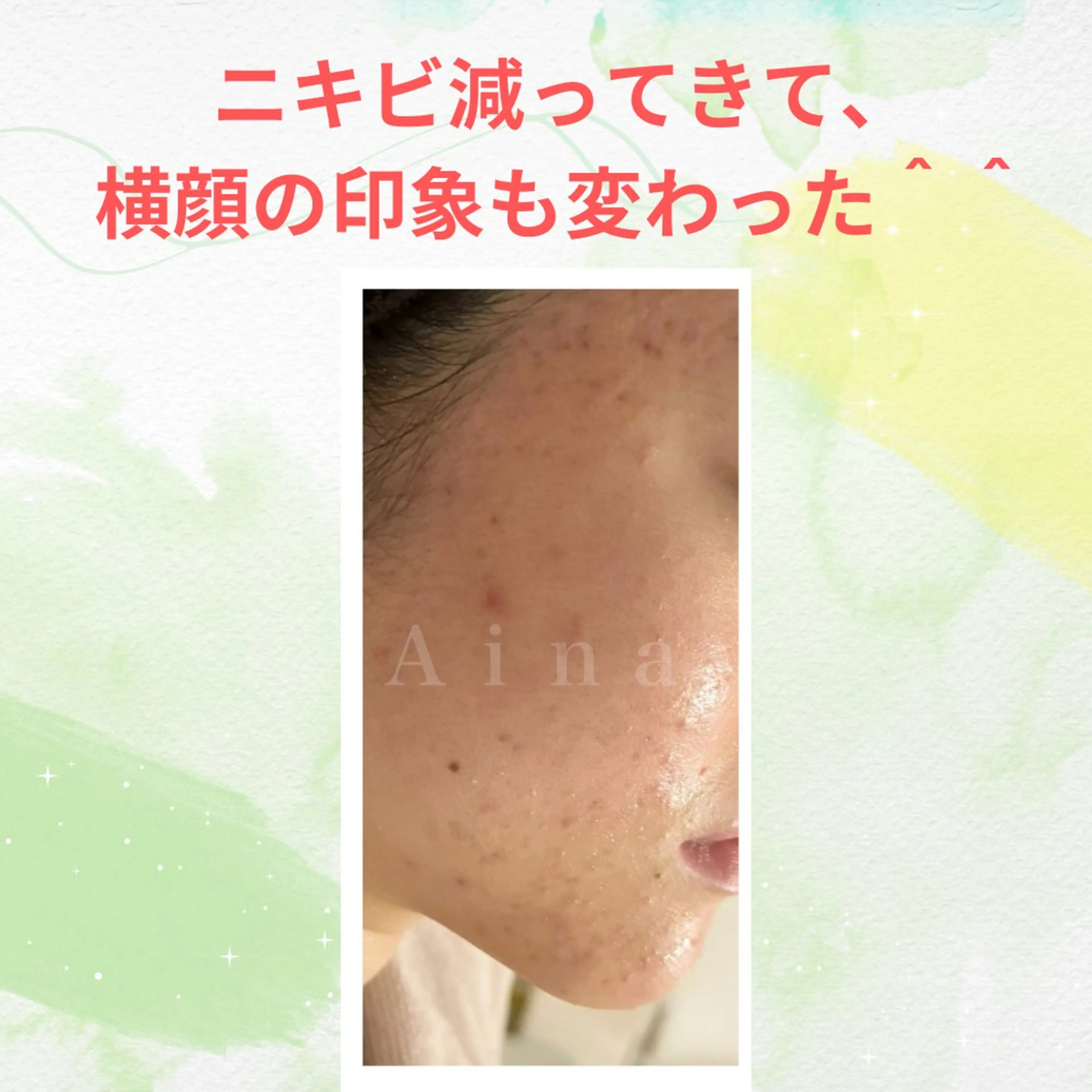 エステ リラク ニキビ跡専門サロン Ainaのエステ・リラクイメージ