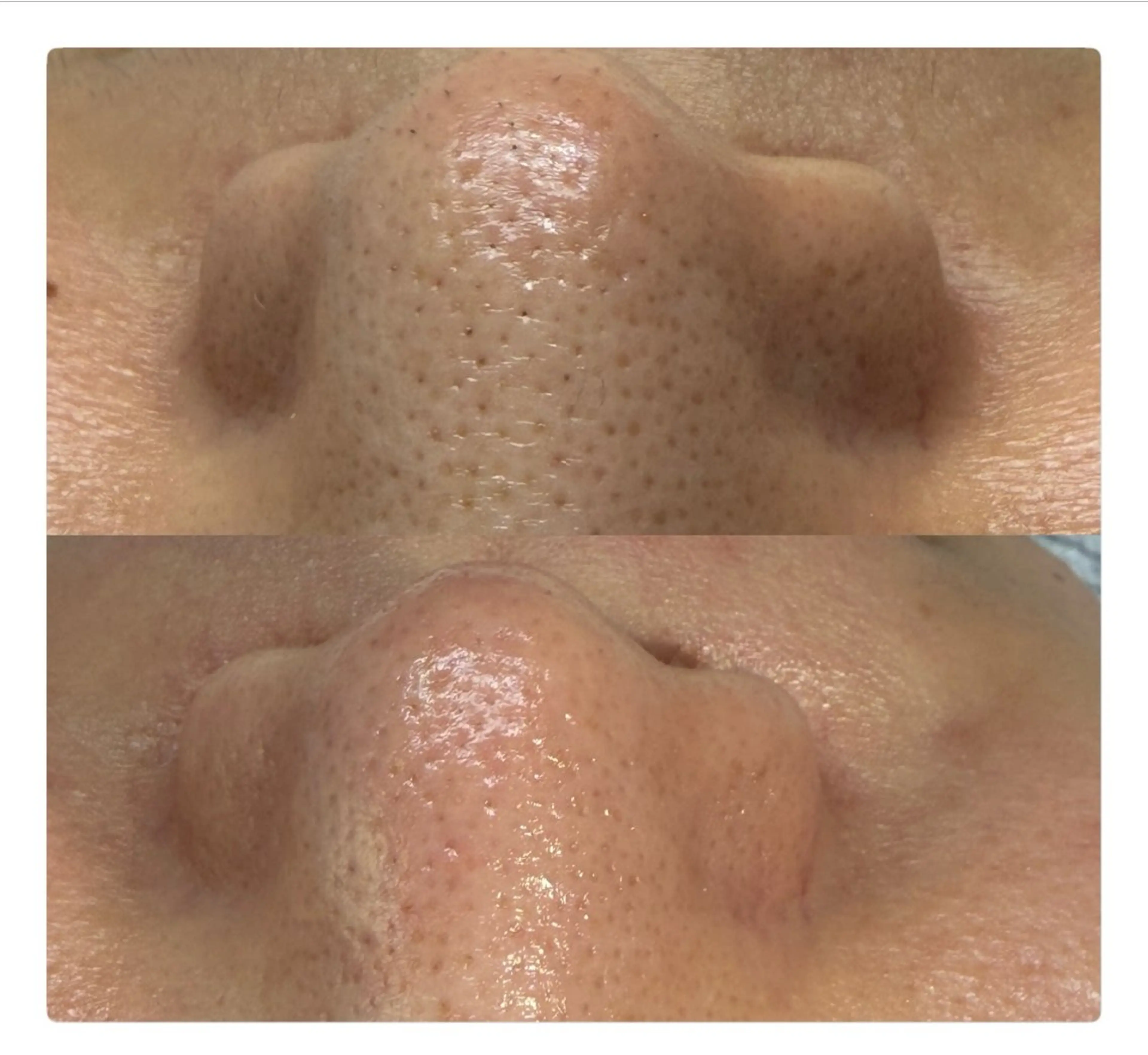 フェイシャルワックス✨️✨️(お肌ツルツル)の写真