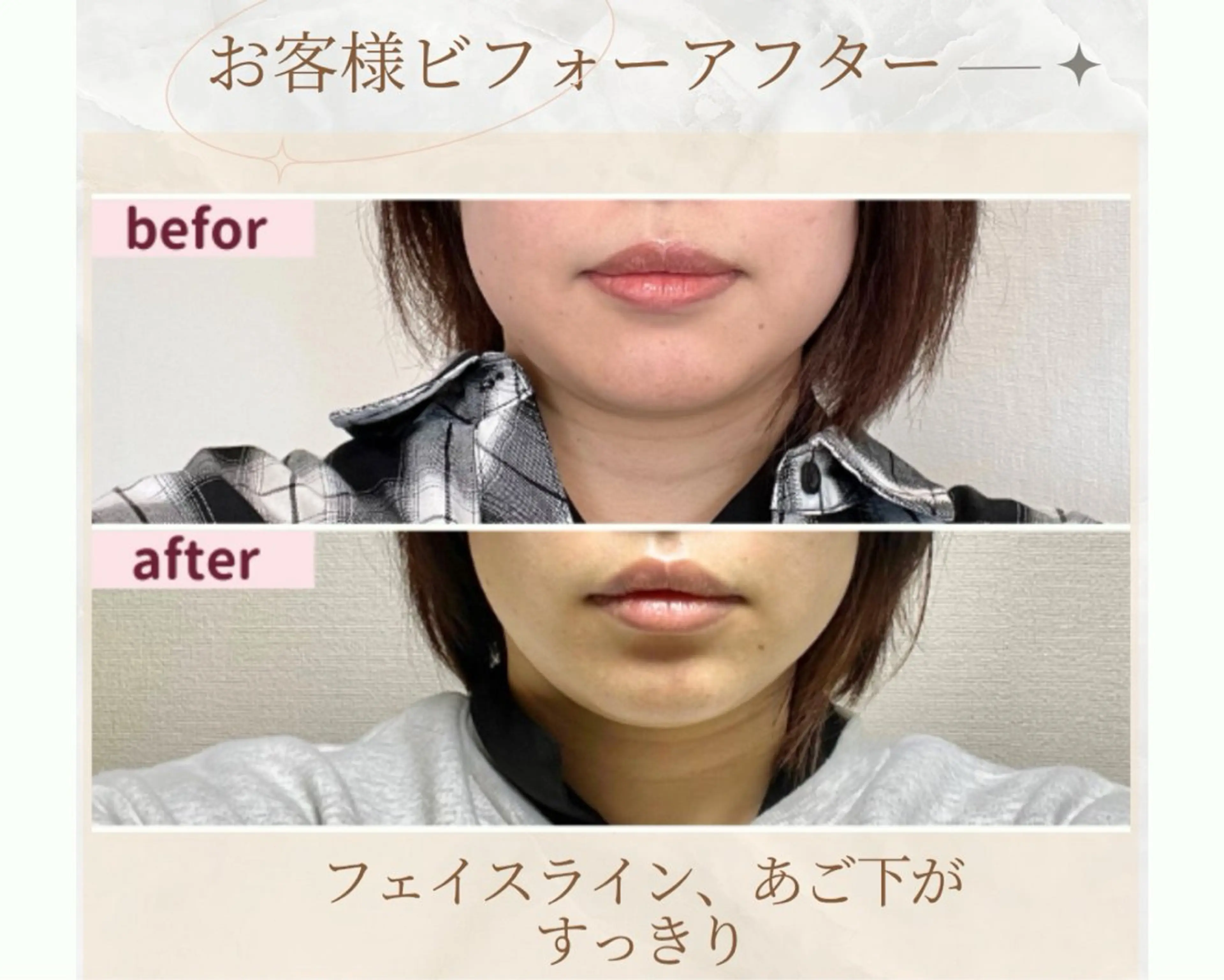 痛くない小顔矯正 いまいあやののその他イメージ