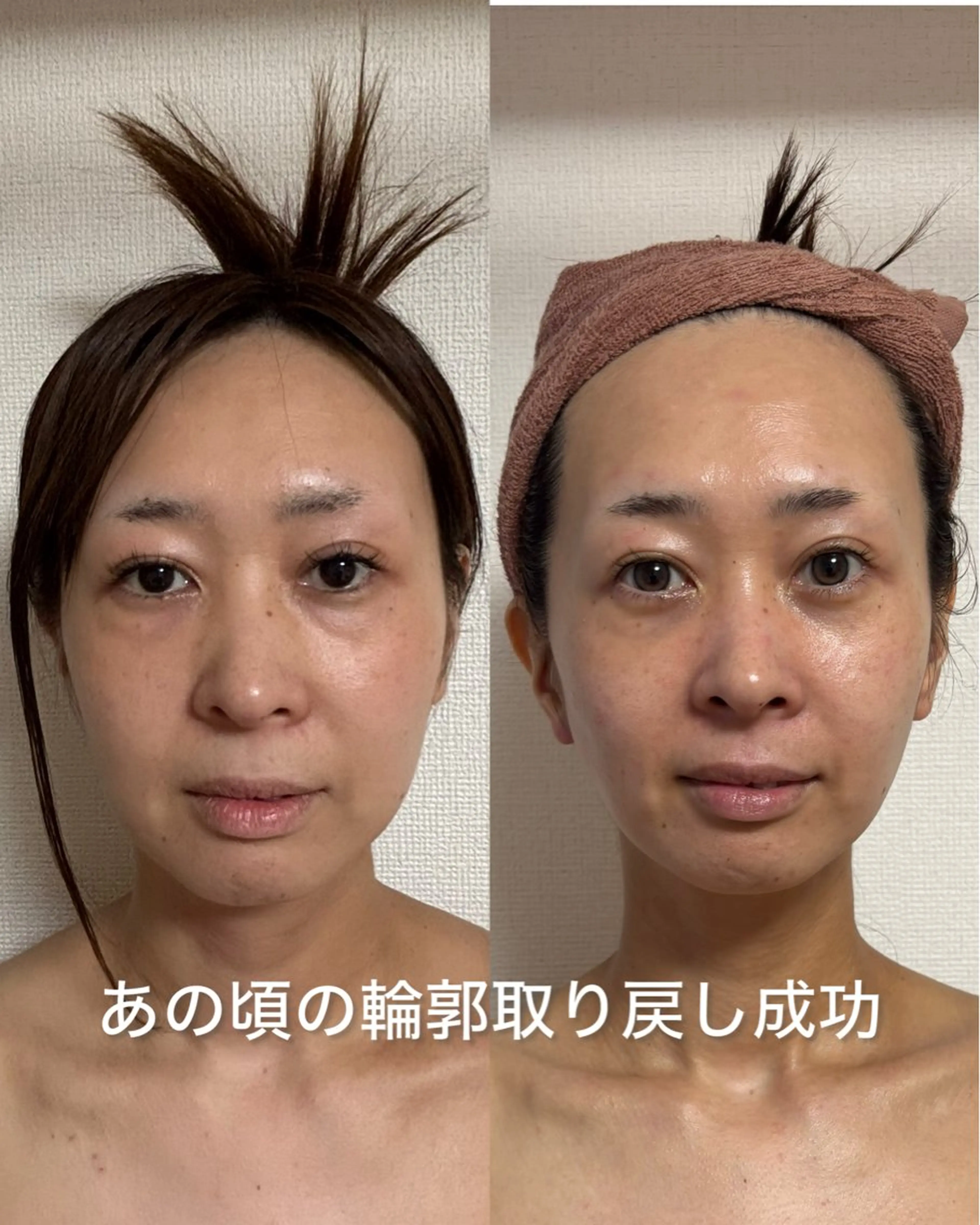 【フェイスライン✨集中ケア】もたつきにアプローチ✨綺麗な笑顔に導く本格フェイシャルケア♡の写真