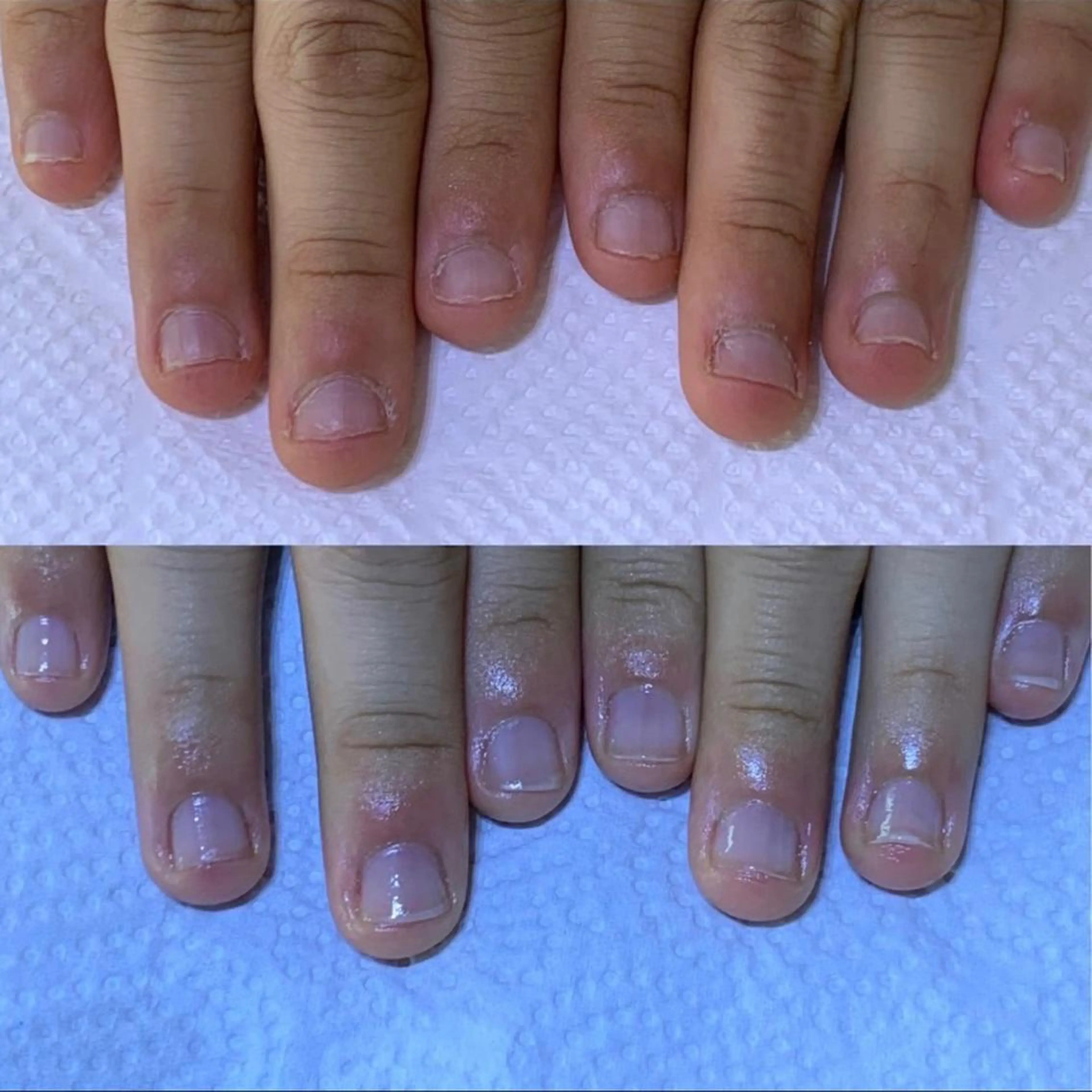 ネイル 自爪育成/深爪矯正 mikiのネイルデザイン