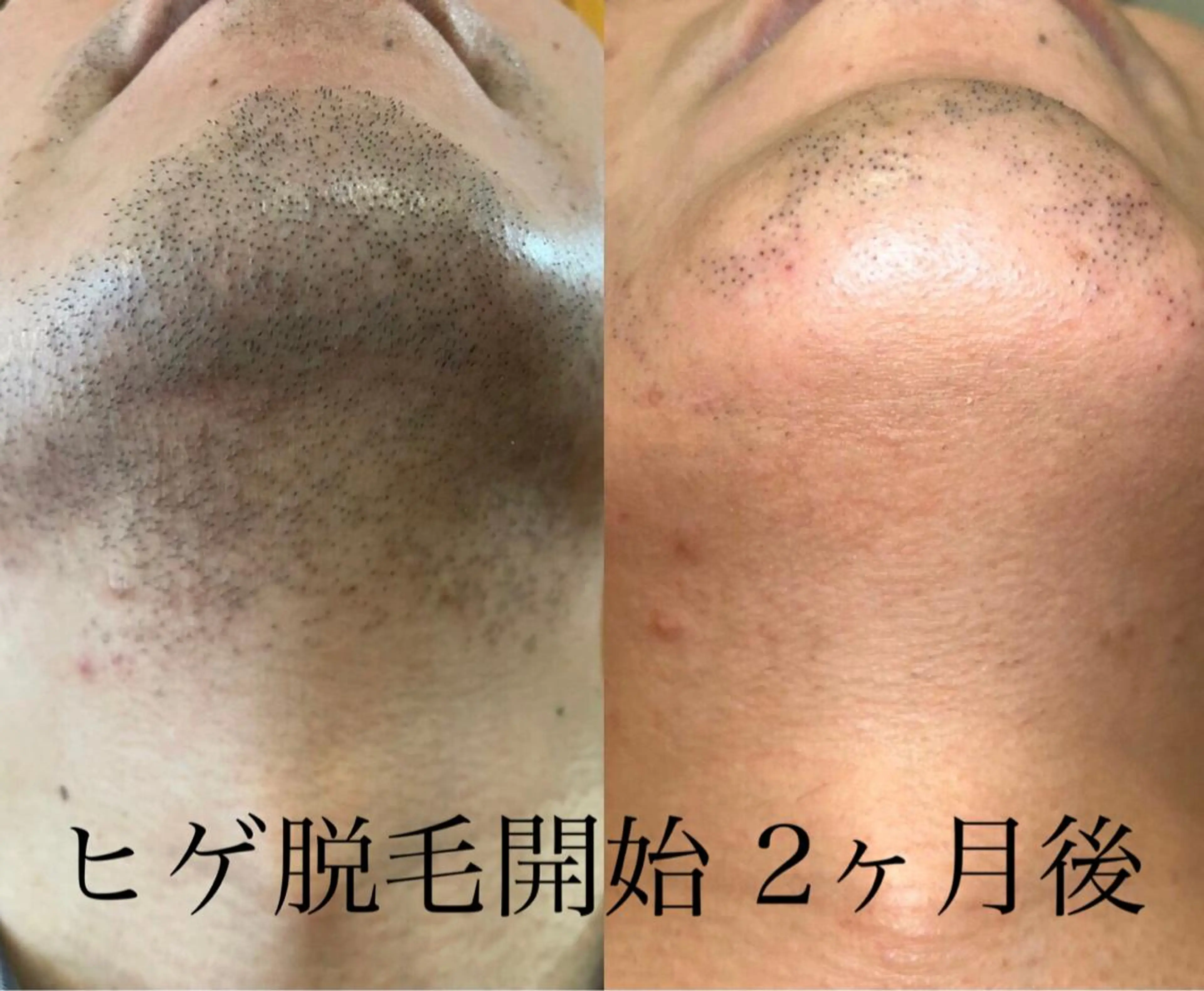 (効果◎)顔+ヒゲ脱毛/メンズの写真