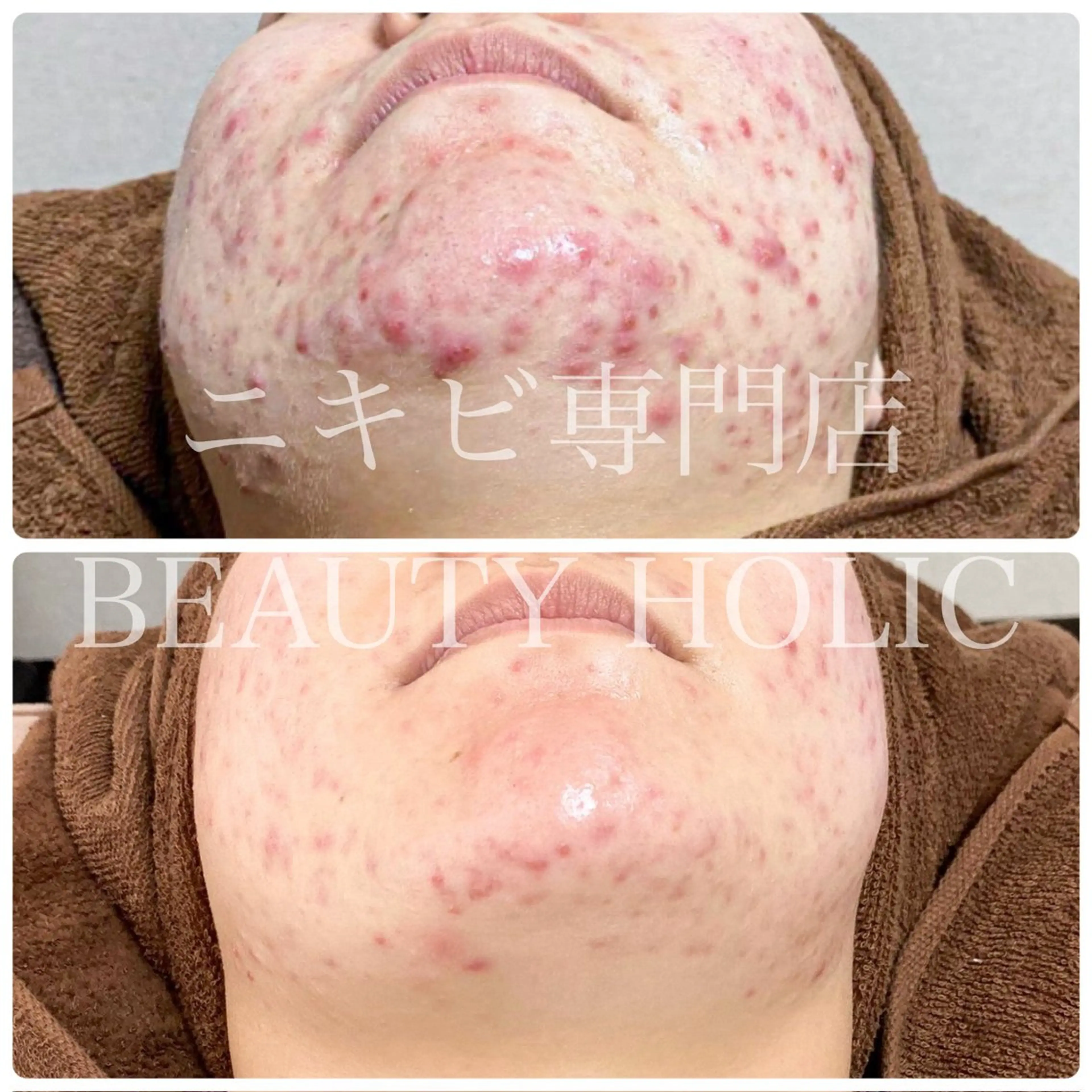 エステ リラク ニキビ・ 肌荒れ専門店のエステ・リラクイメージ