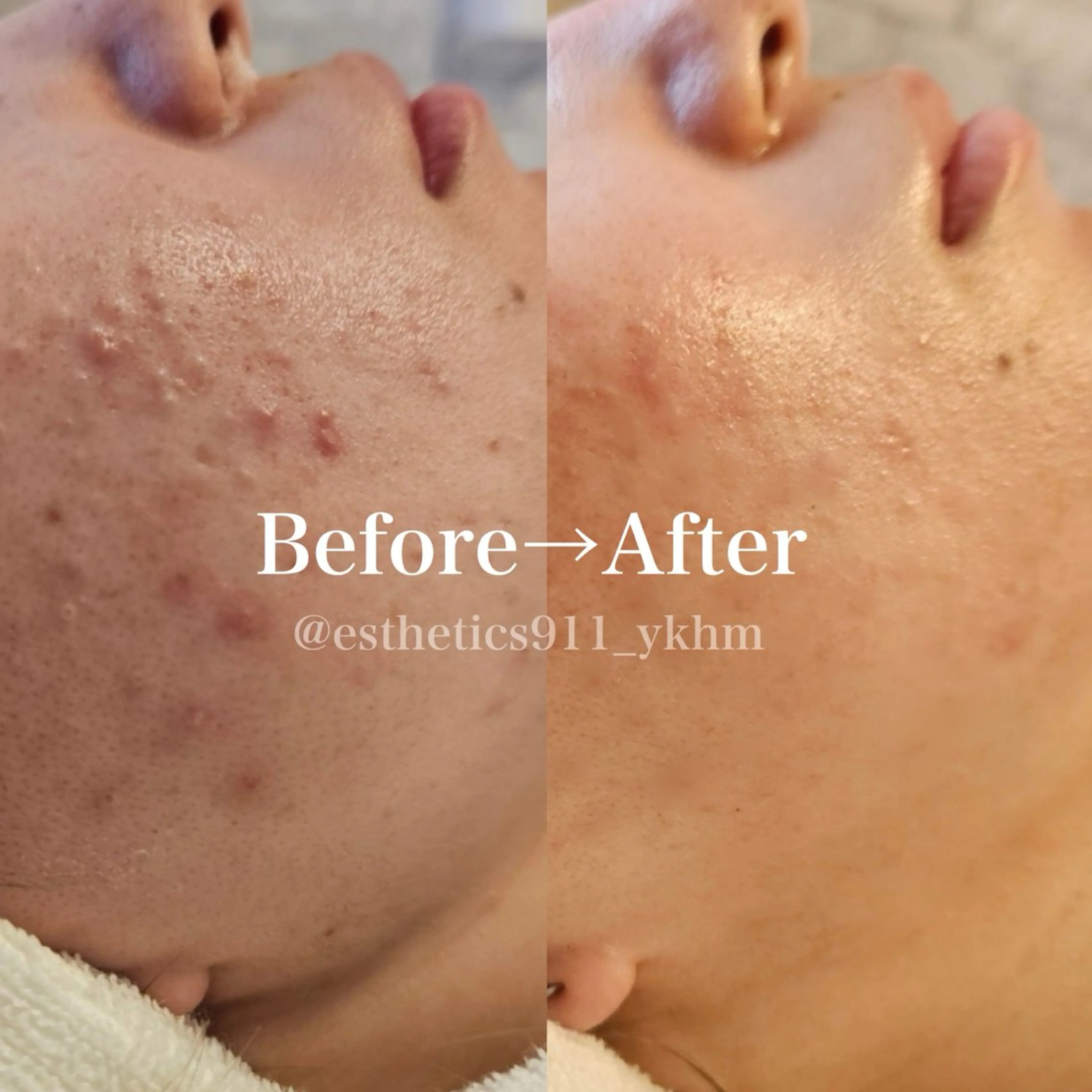 【全営業時間】肌荒れ解決！大人ニキビ毛穴ケア！水素高周波のWアプローチ！フェイシャルエステ体験の写真