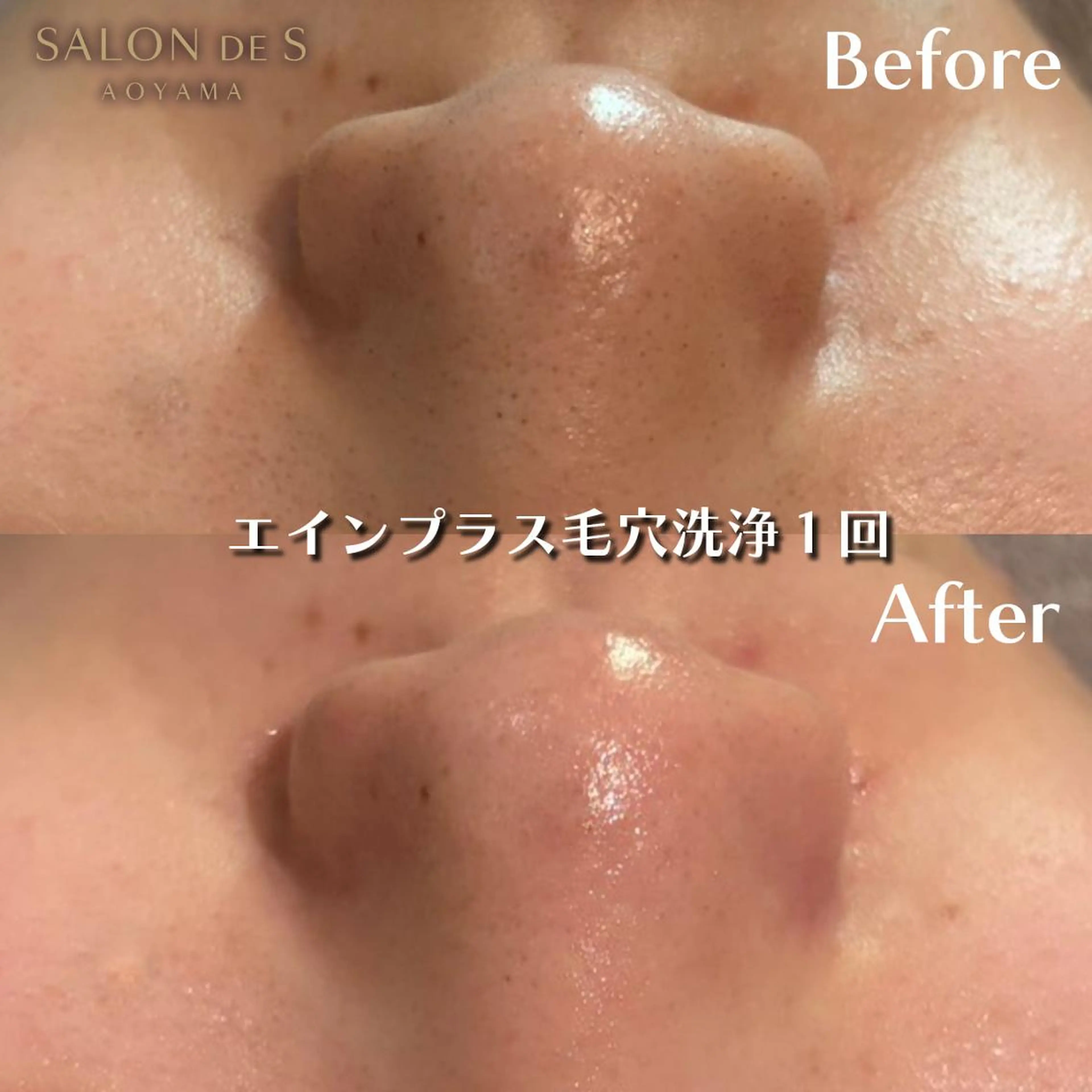 最新毛穴洗浄🫧クリニックで導入されているエインプラスでちゅるちゅる卵肌🥚🤍の写真