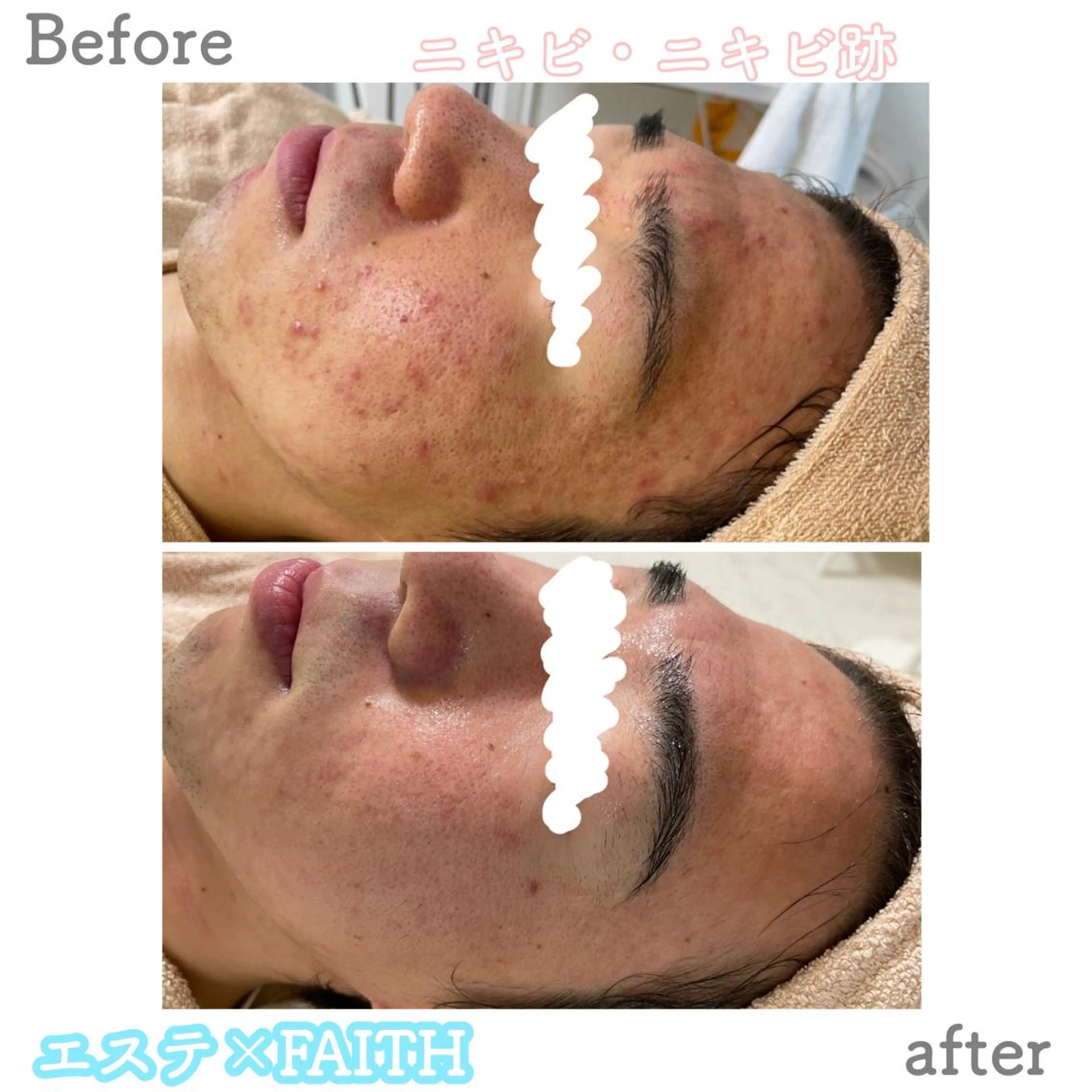 エステ ニキビ&跡改善サロン オーナー光木のエステ・リラクイメージ