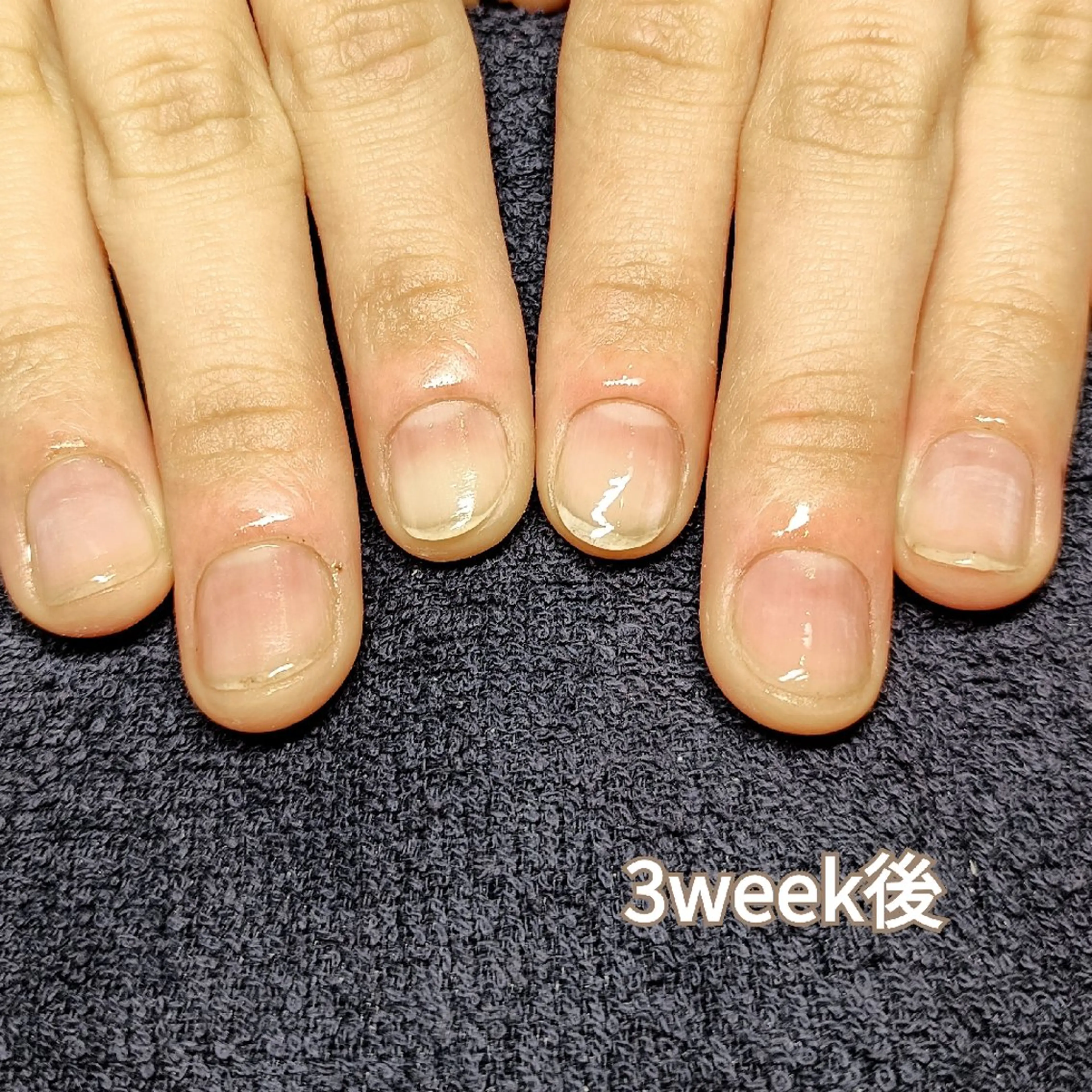 ネイル 長さ出し ハンドネイル ハンドケア 深爪矯正/爪育成ケア manie nailのネイルデザイン