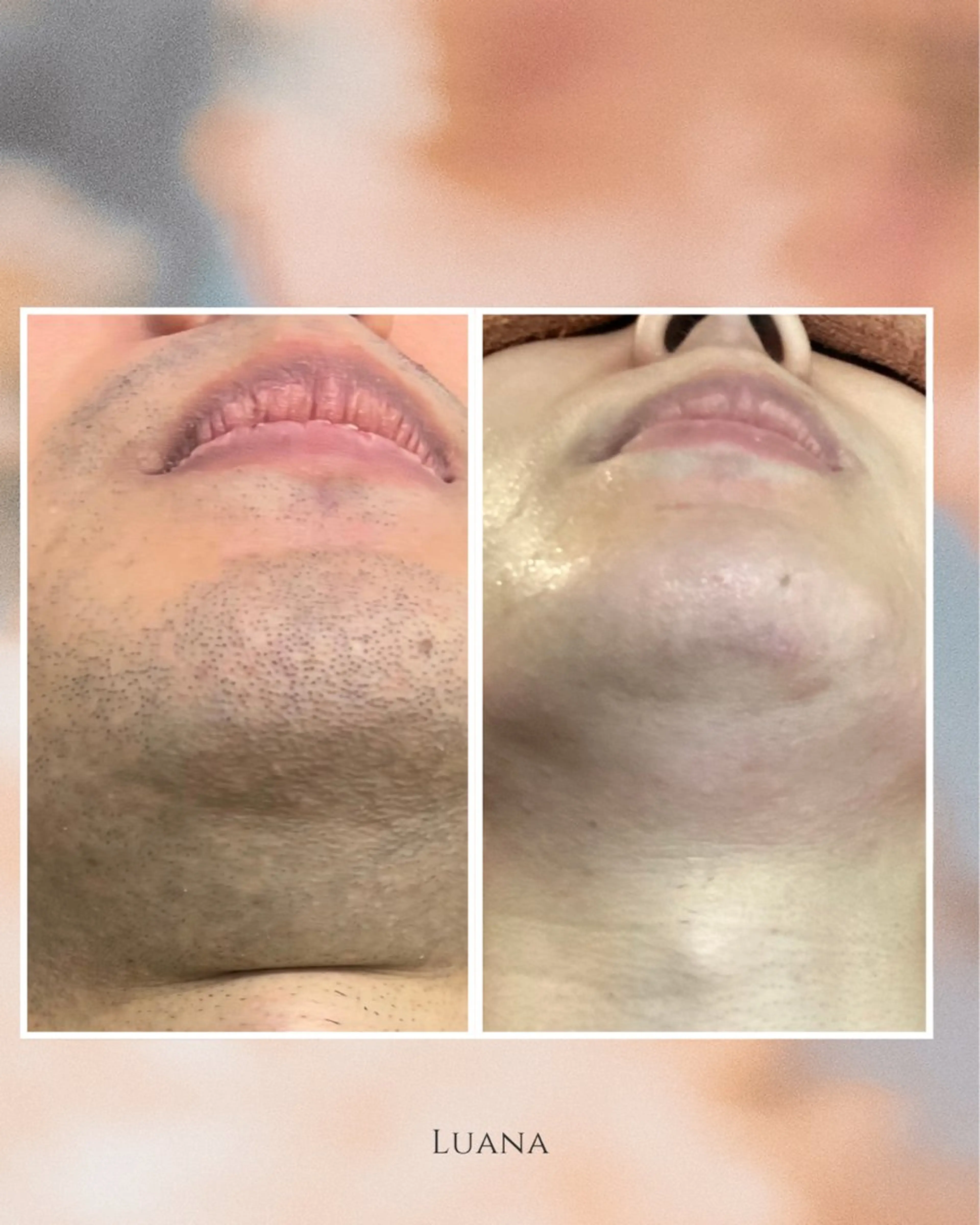 『目指せ爽やか男子』メンズお髭脱毛！！！の写真