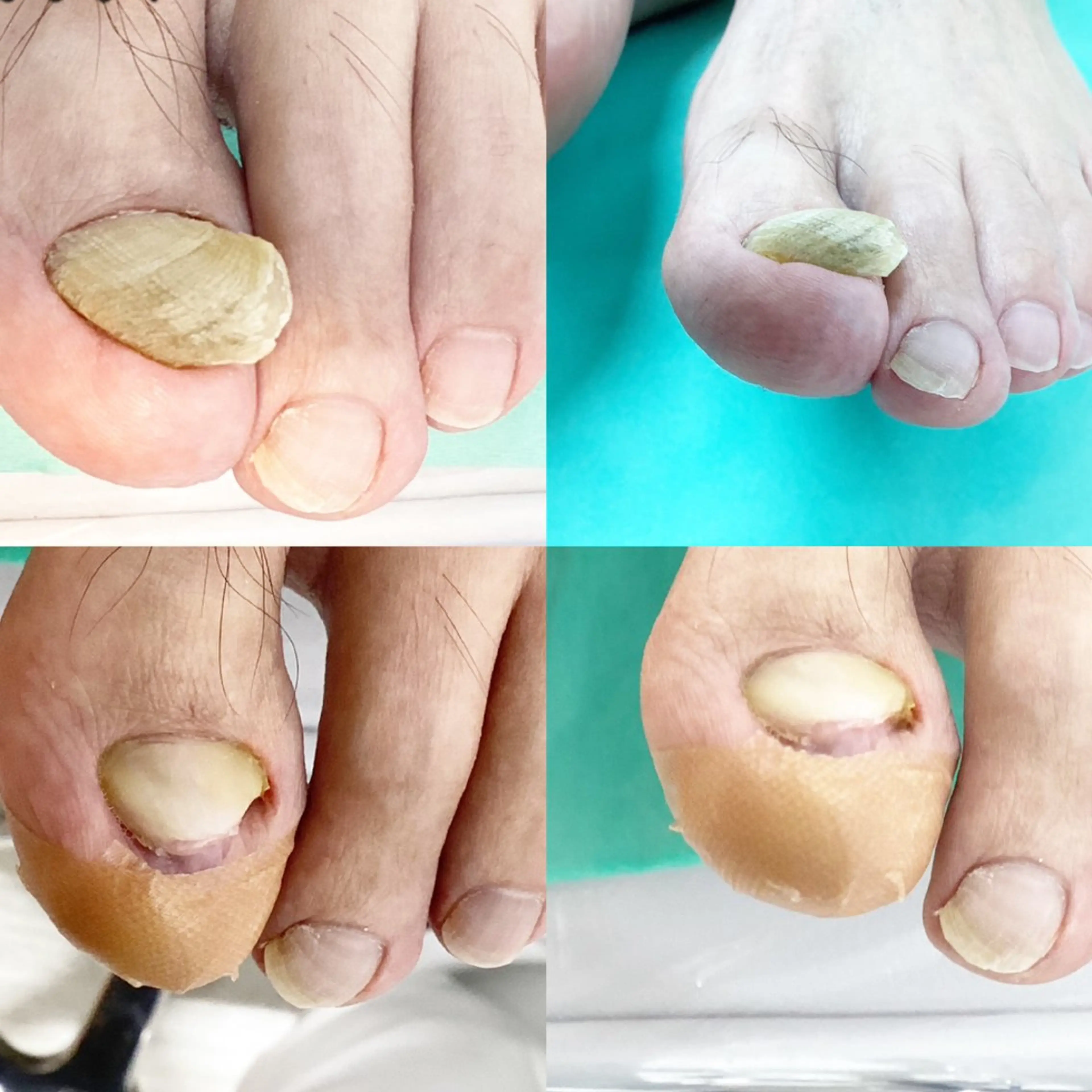 【変形爪1本】分厚い爪、変形爪を元のような元気なお爪に戻す施術です。の写真