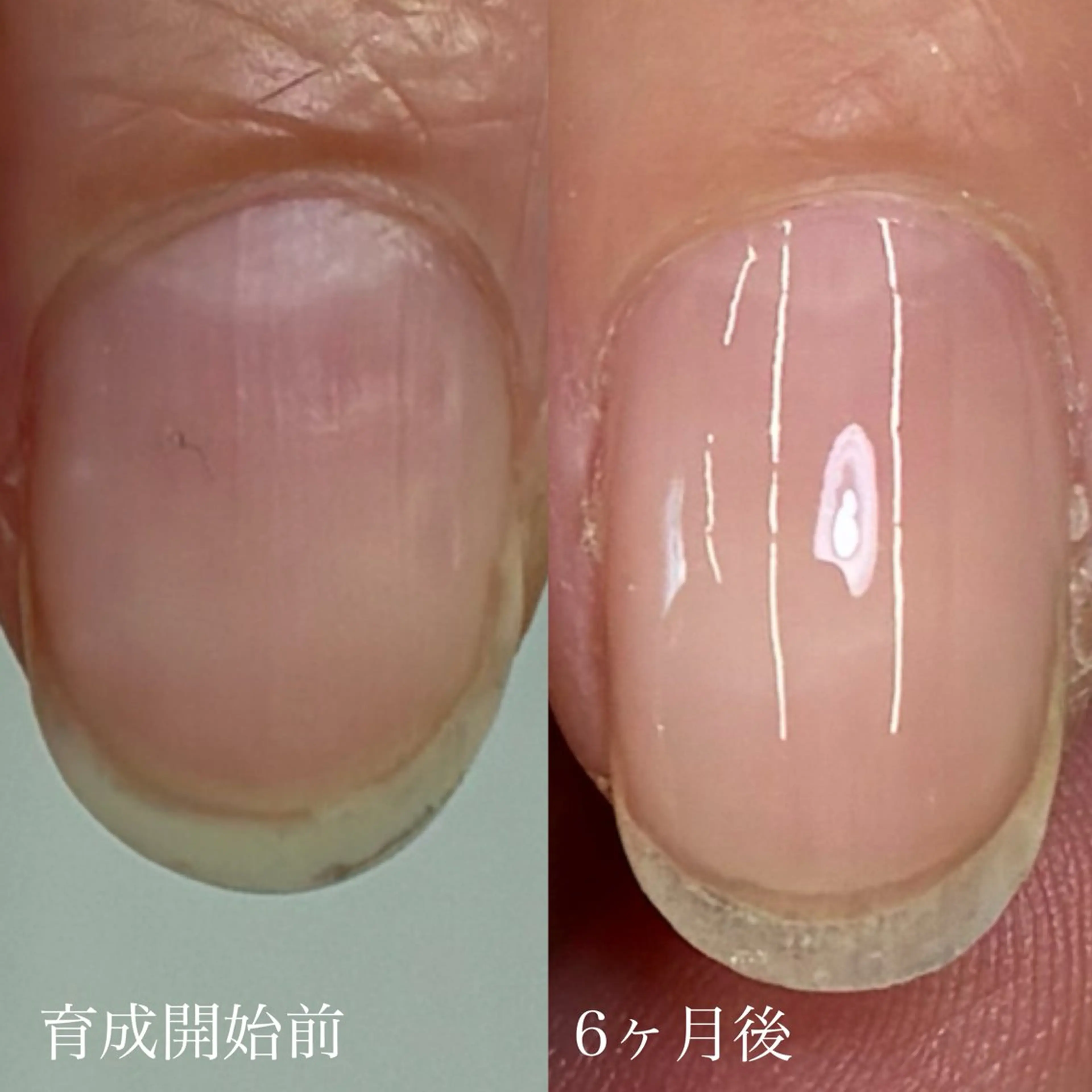 ネイル ハンドネイル ハンドケア 広島市南区(広島県) /深爪/自爪育成のネイルデザイン