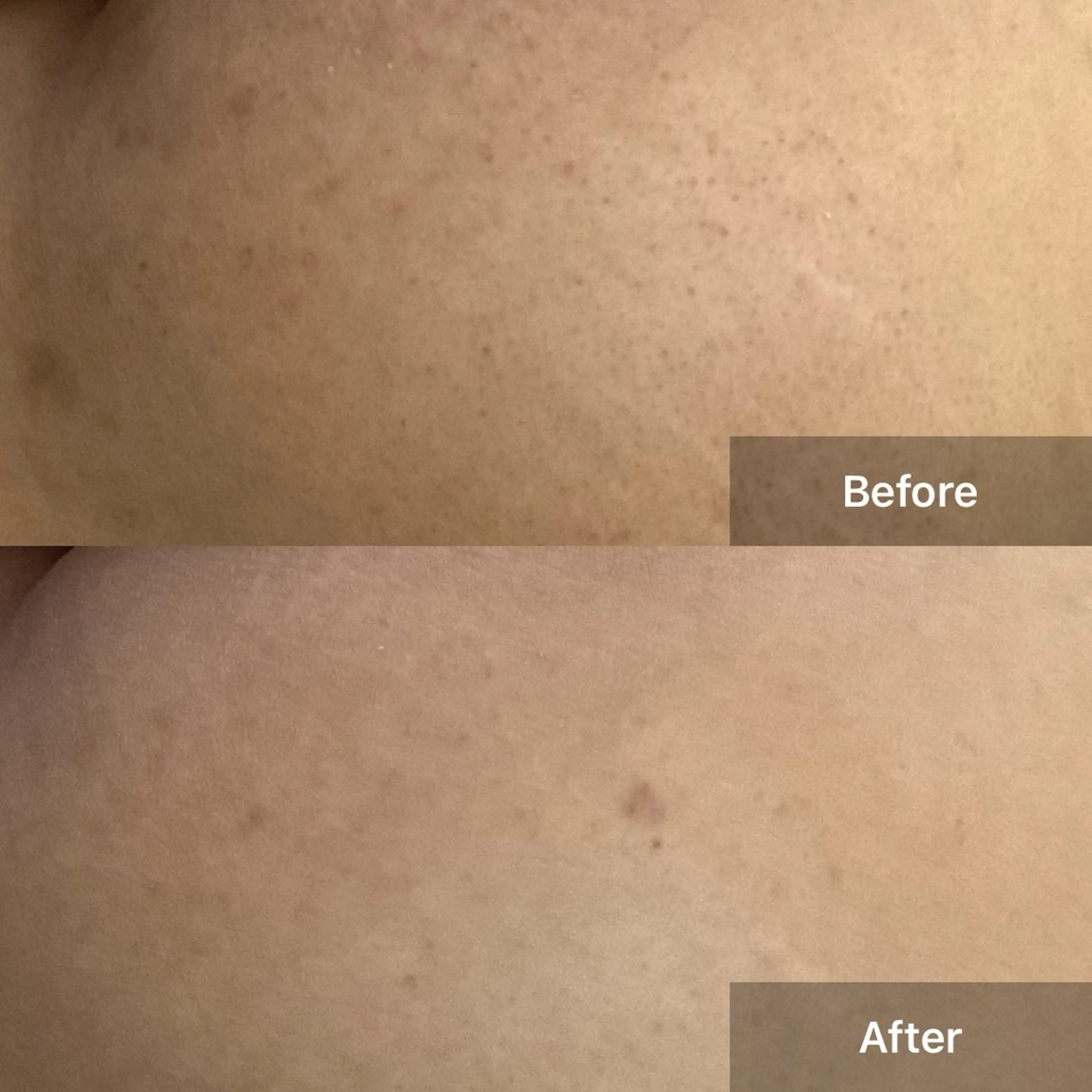 🌿お尻特化メニュー✨【剥離あり】【毛穴洗浄】【GF美容液】ニキビ/ニキビ跡/黒ずみ/水光肌/毛穴ケア/ゴワつき/毛孔性の写真