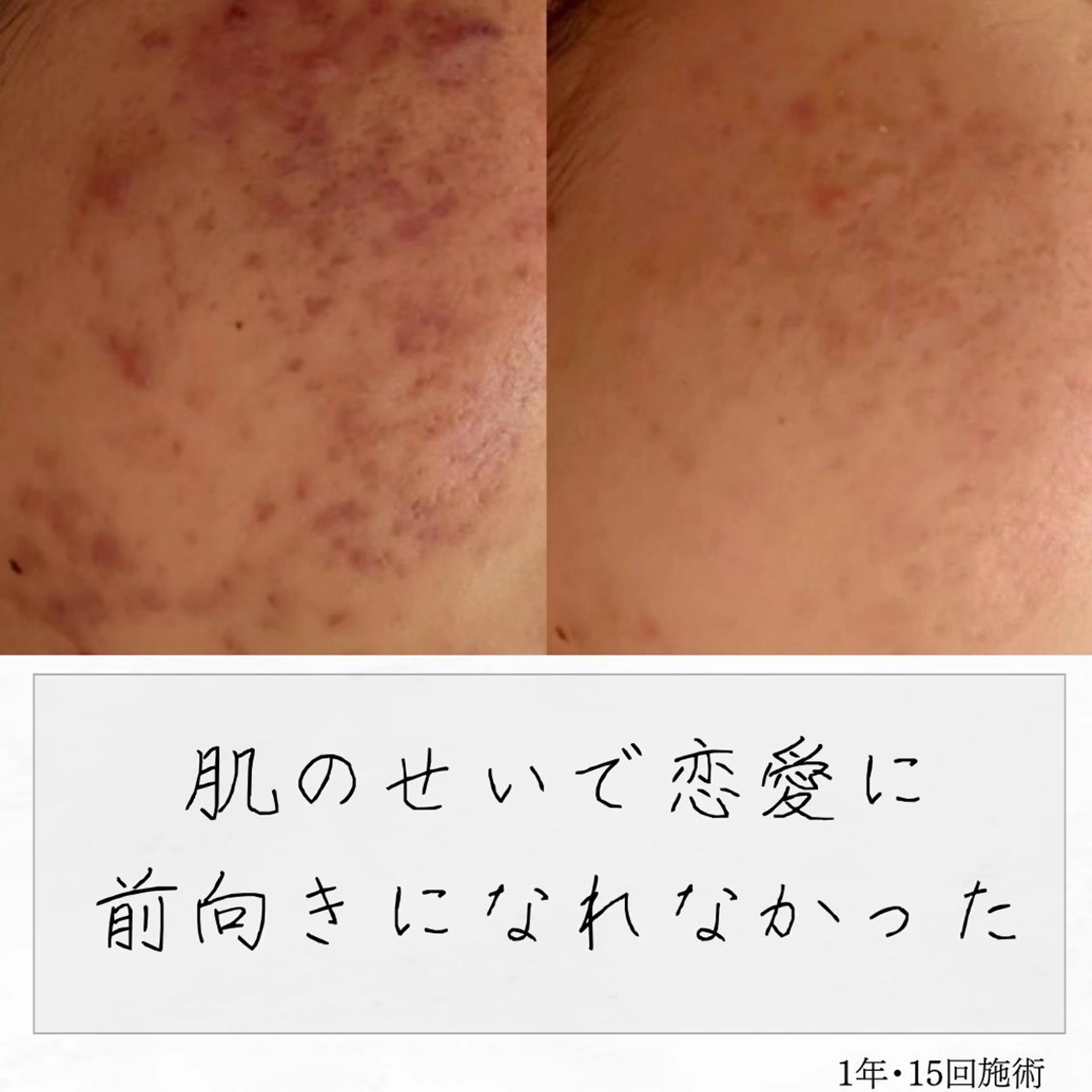 ニキビ経験者が施術 する専門サロン🌻のエステ・リラクイメージ