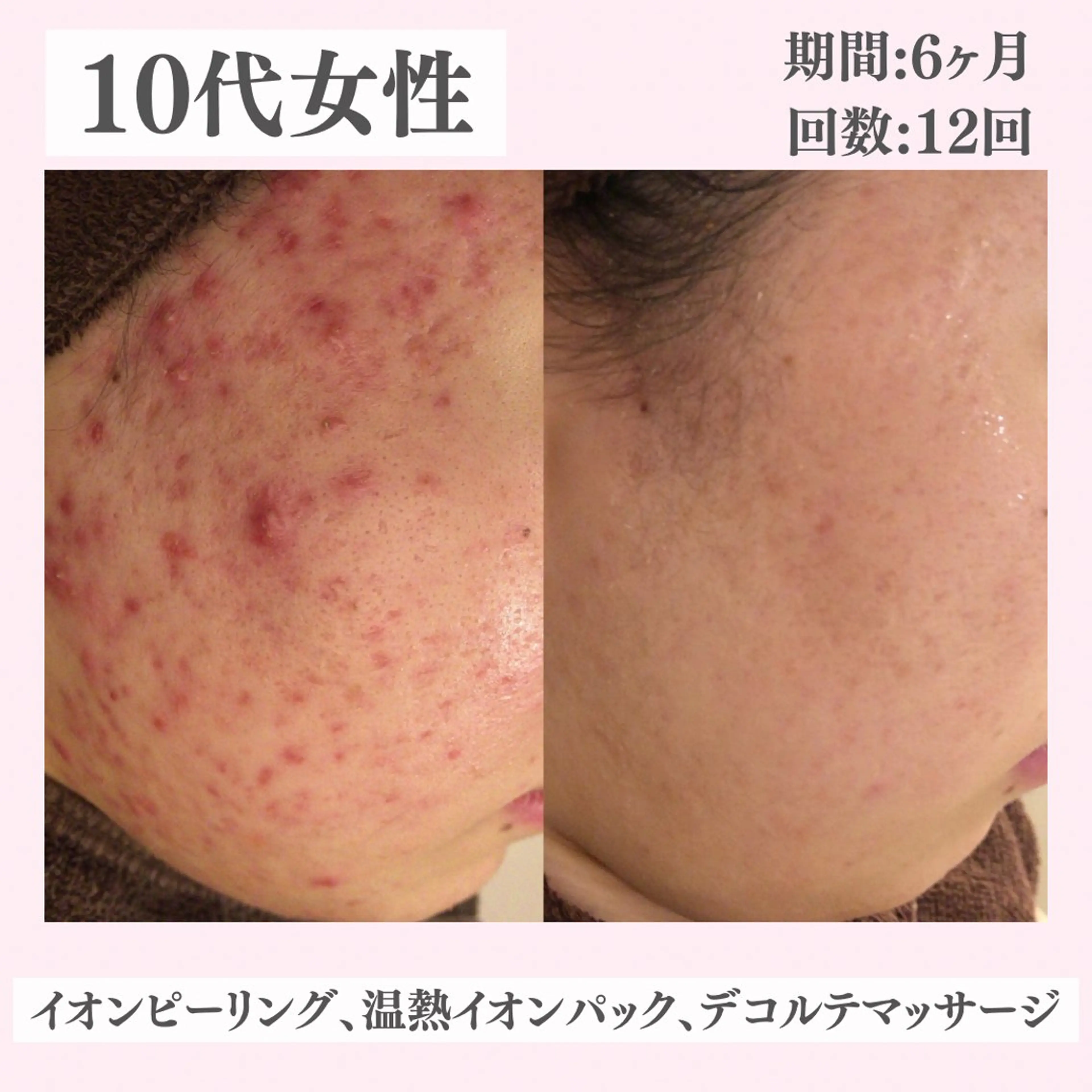 エステ リラク ニキビ・肌質改善専門 ♡人生が変わるサロンのエステ・リラクイメージ