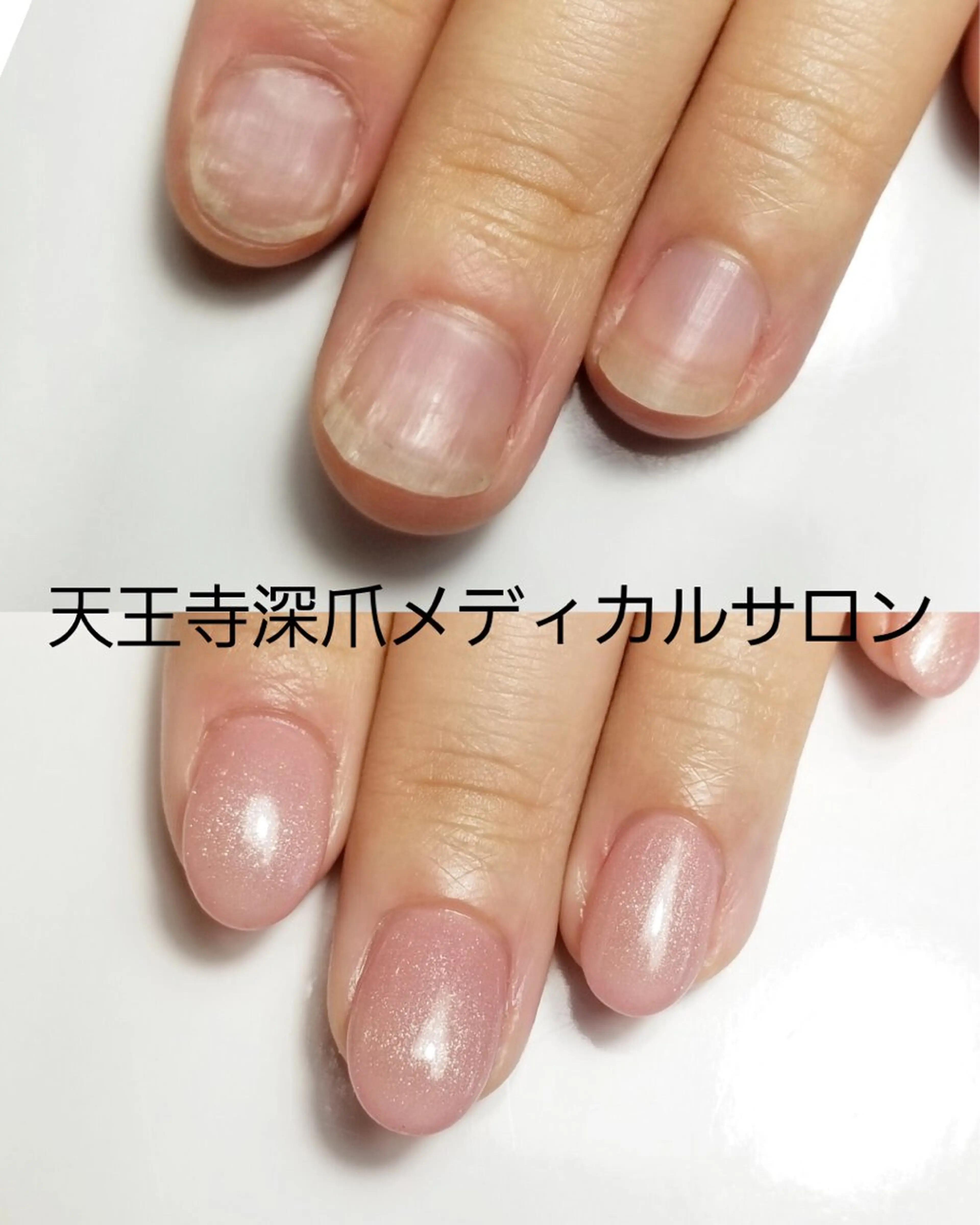 ネイル ハンドネイル ハンドケア 天王寺 深爪メディカルサロンのネイルデザイン