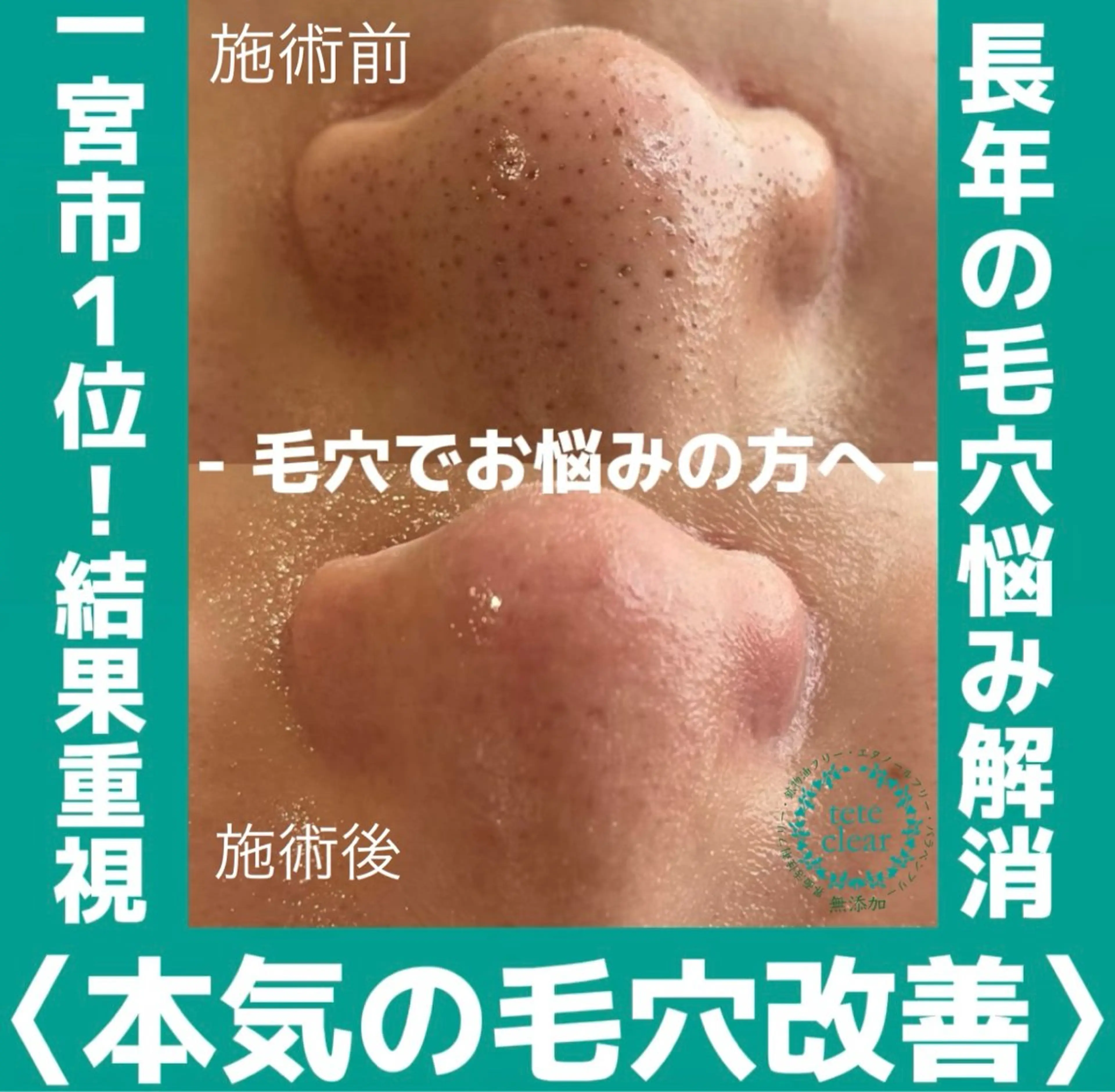 【SNSで話題結果重視！】最高峰の毛穴ケア🫧毛穴エクストラクション❤️‍🔥幹細胞パックプレゼント🎁の写真