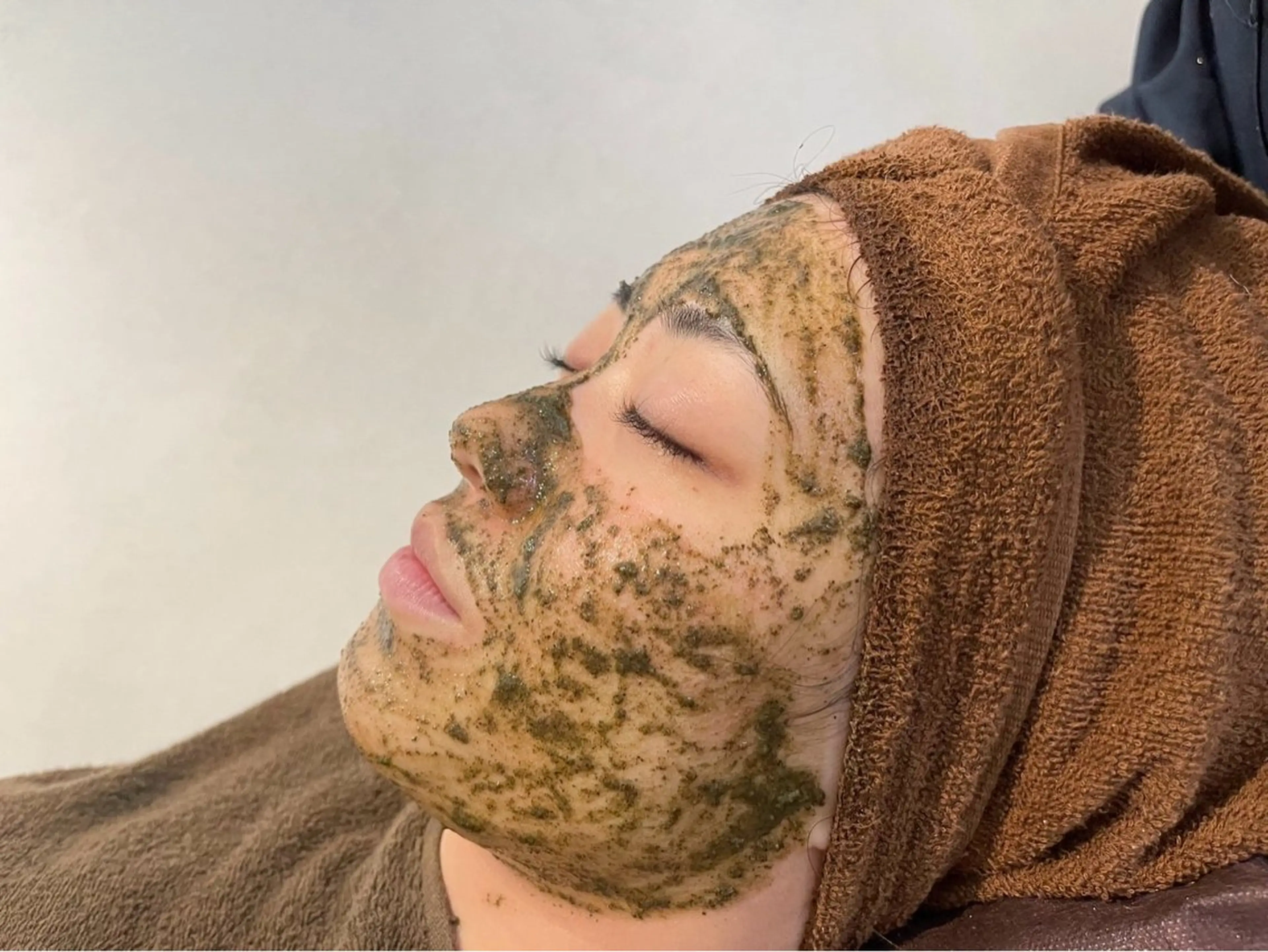 50%OFF🌼【ニキビ、頑固なニキビケア3回分セットクーポン✨】REVIハーブピーリング🌿の写真