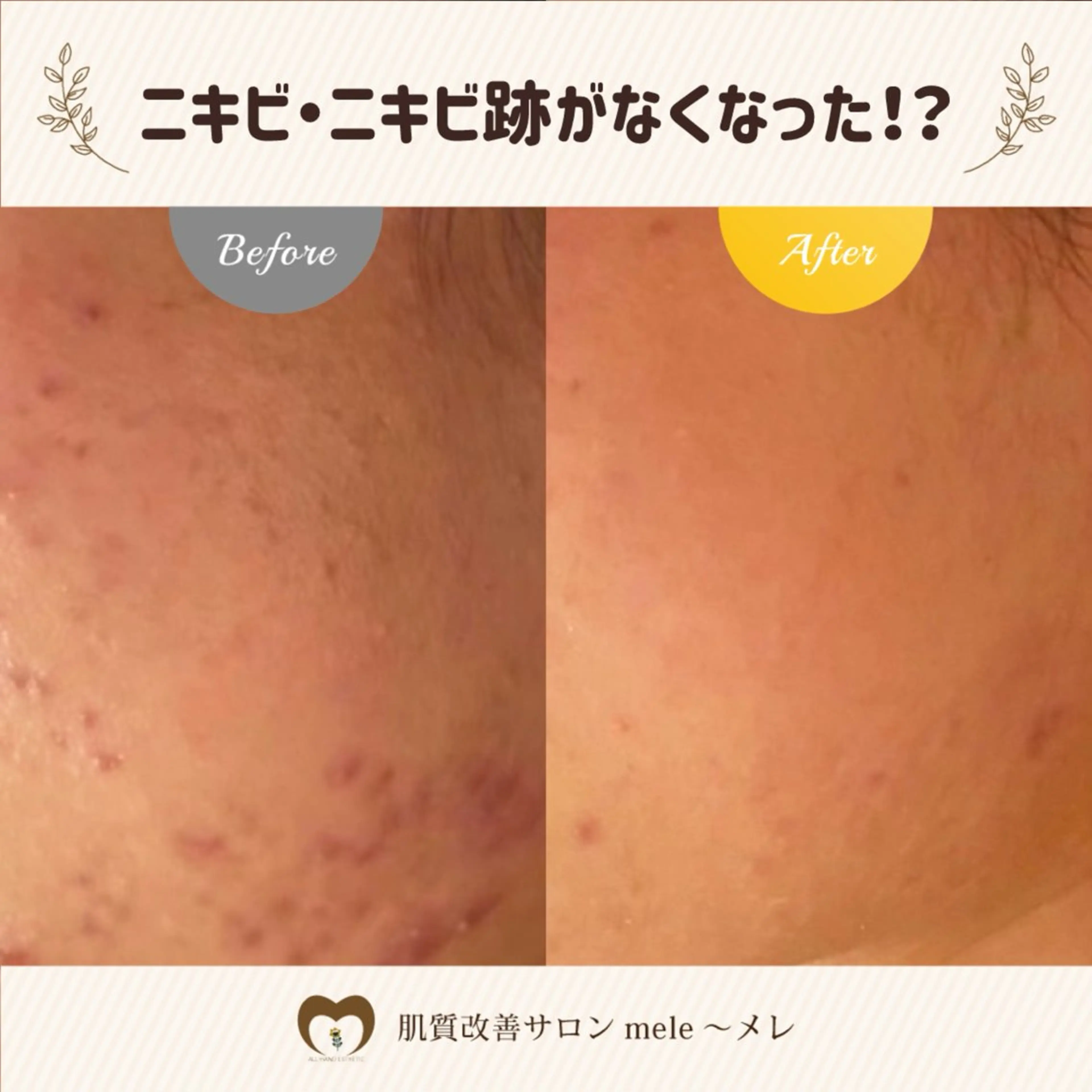 繰り返すニキビ・毛穴 ✨つくば肌質改善専門のエステ・リラクイメージ